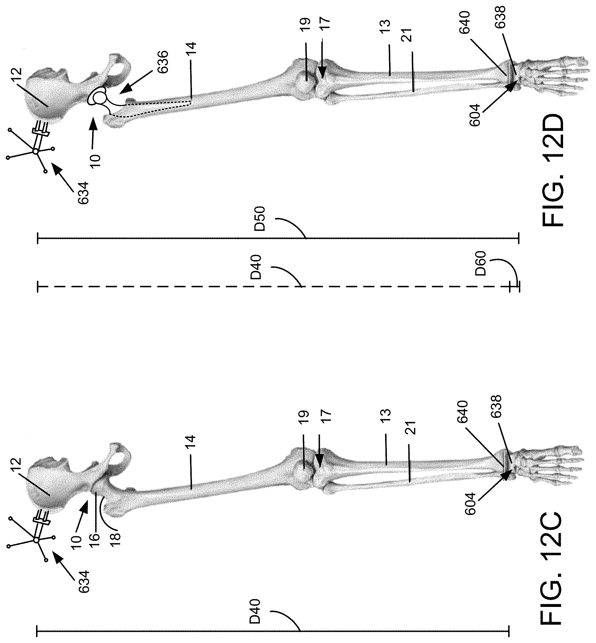 Patent US11771498 Figure 16 – Lower extremities leg length calculation method