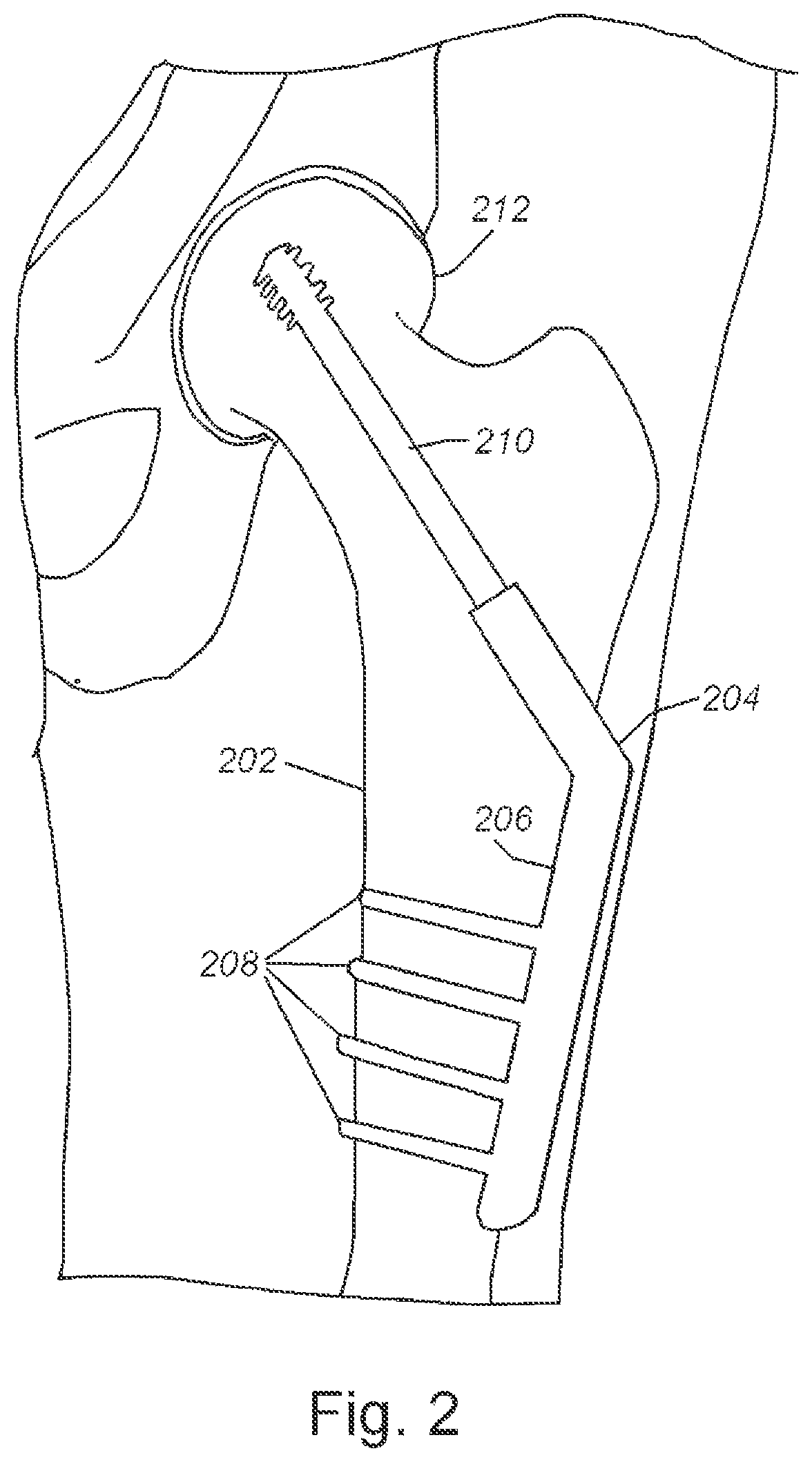 Patent US11771503 Figure 2 – Screen-mounted trajectory and aiming guide for use with fluoroscopy