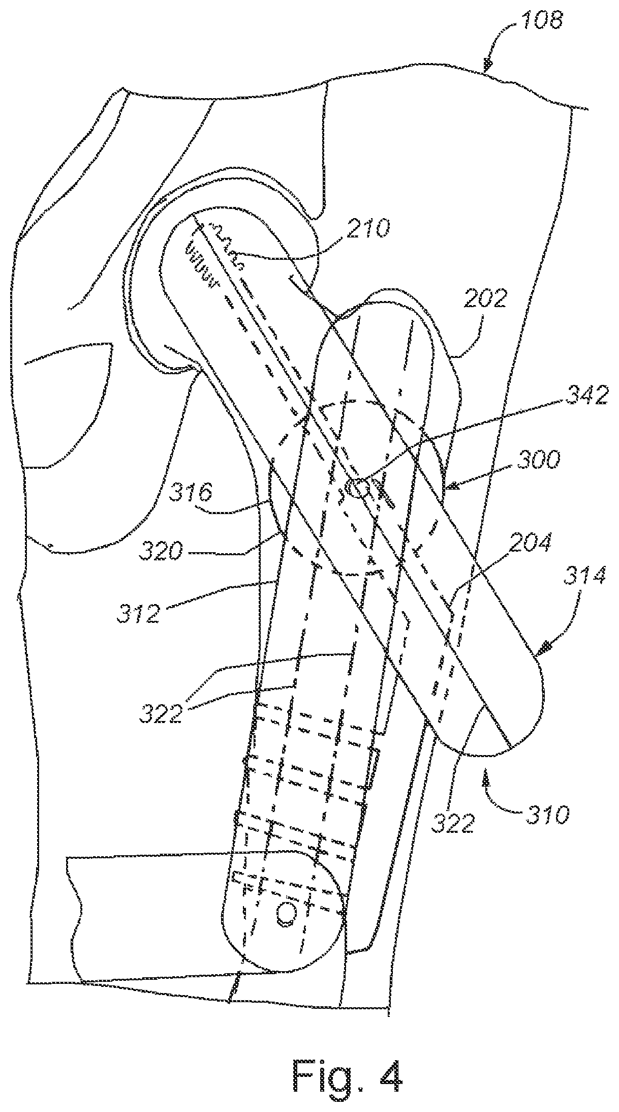 Patent US11771503 Figure 4 – Screen-mounted trajectory and aiming guide for use with fluoroscopy
