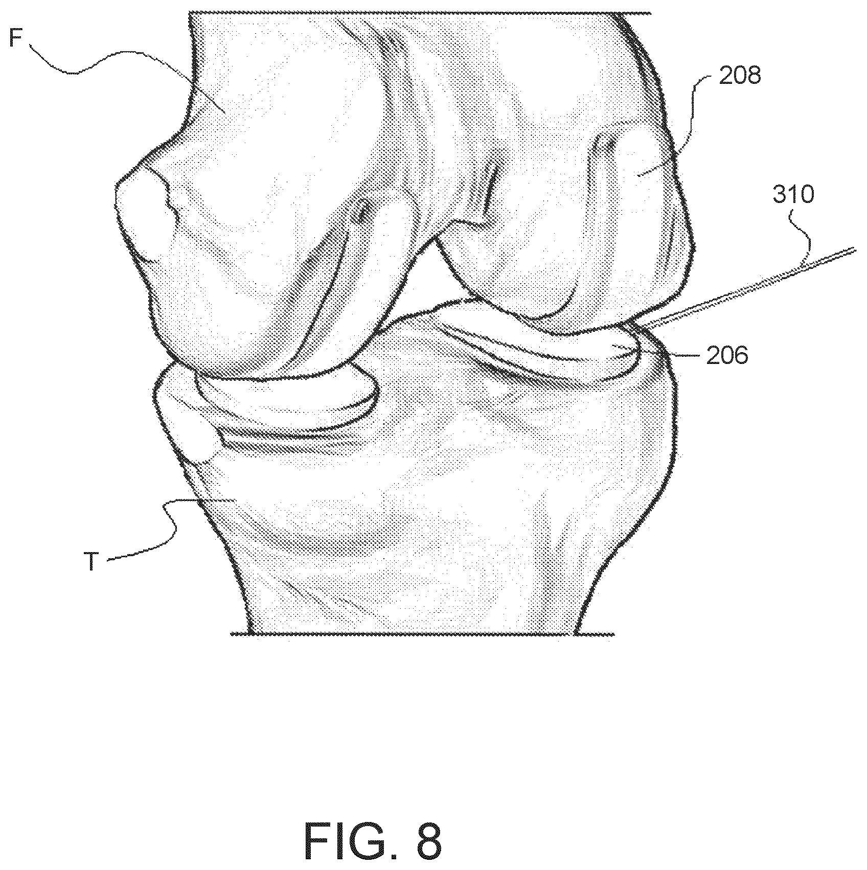 Patent US11771504 Figure 12 – Surgical system with base and arm tracking