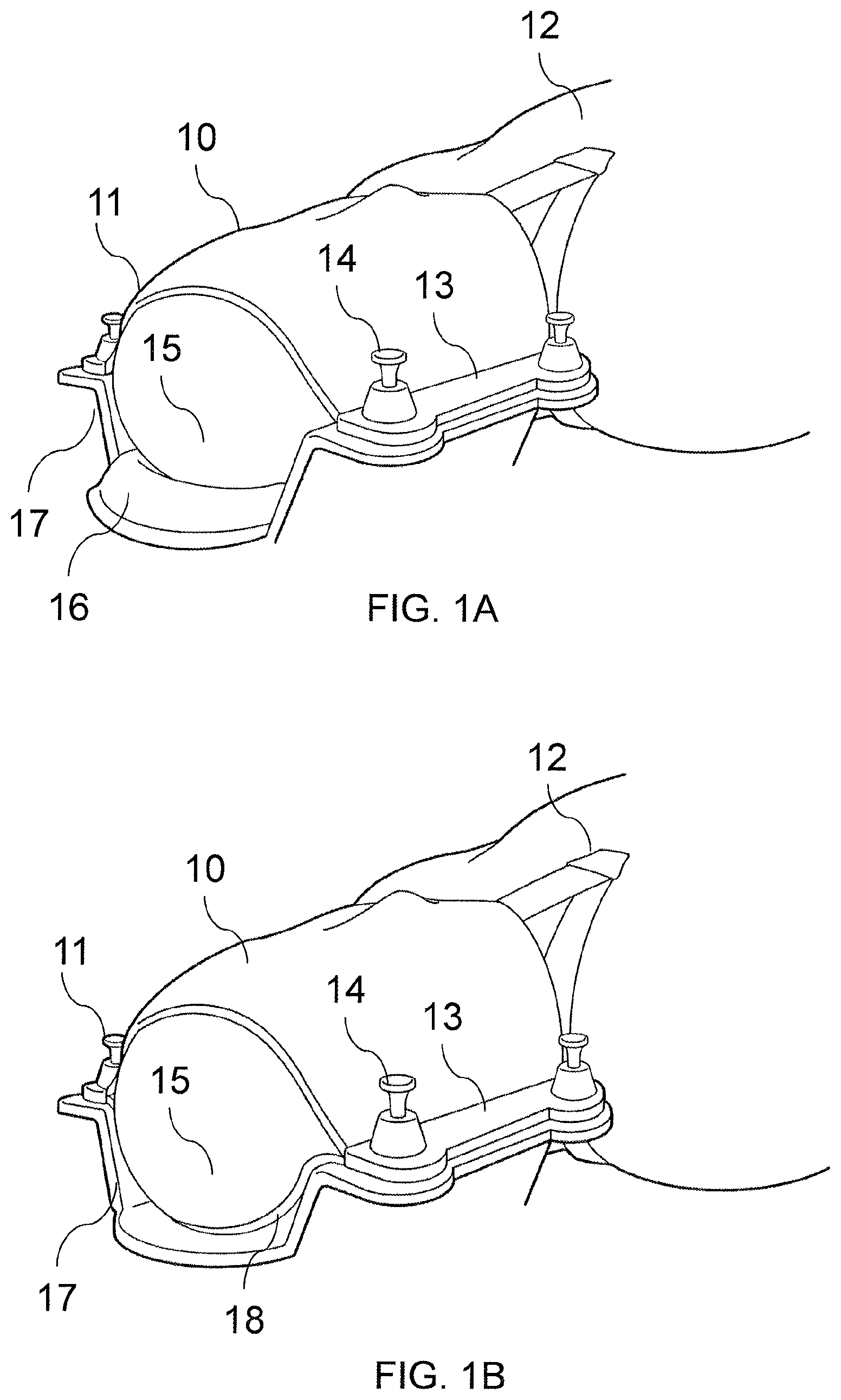 Patent US11771516 Figure 1 – Adjustable immobilizer apparatus and method for immobilizing a patient