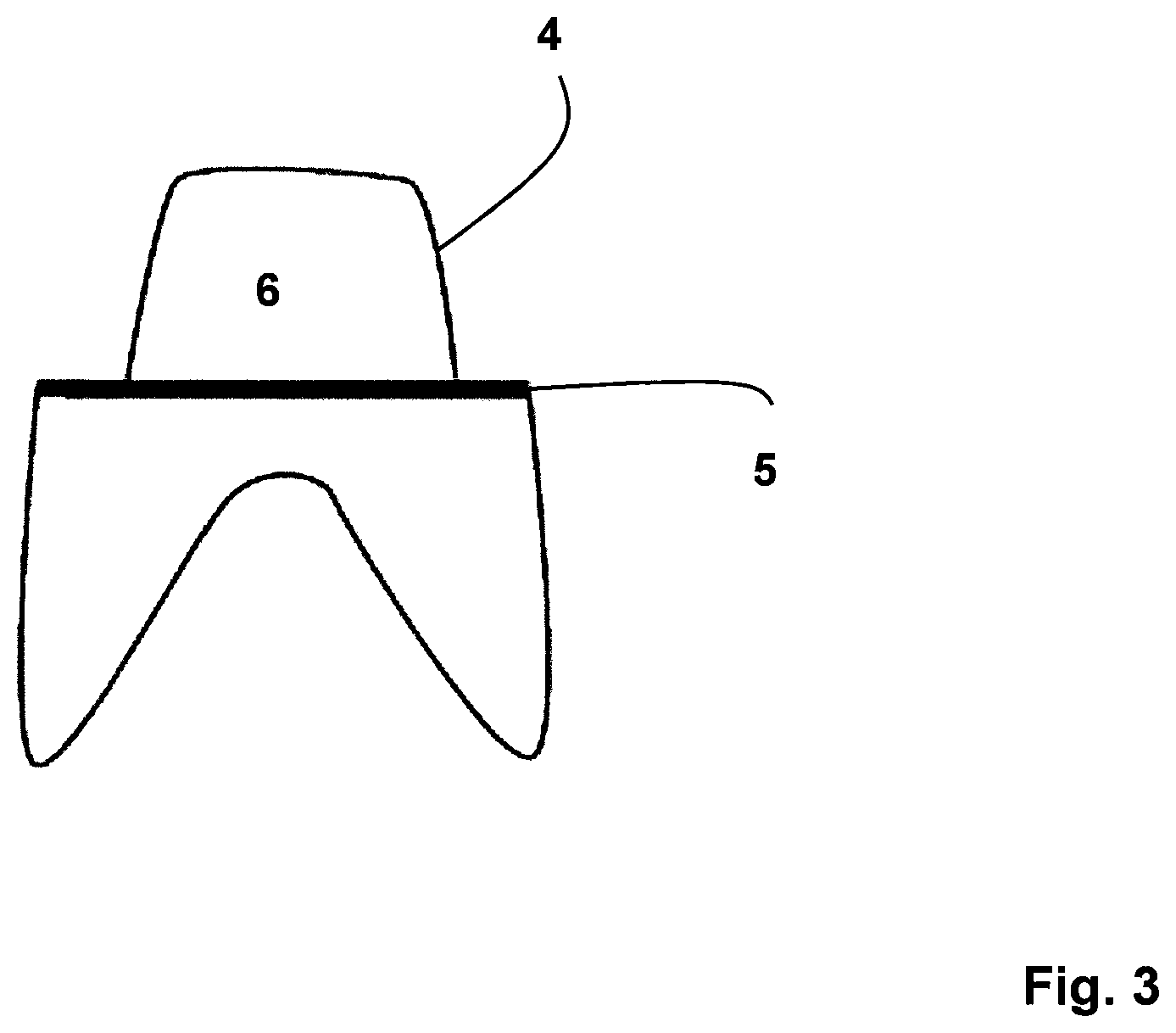 Patent US11771523 Figure 3 – Method for the design and manufacture of a dental component