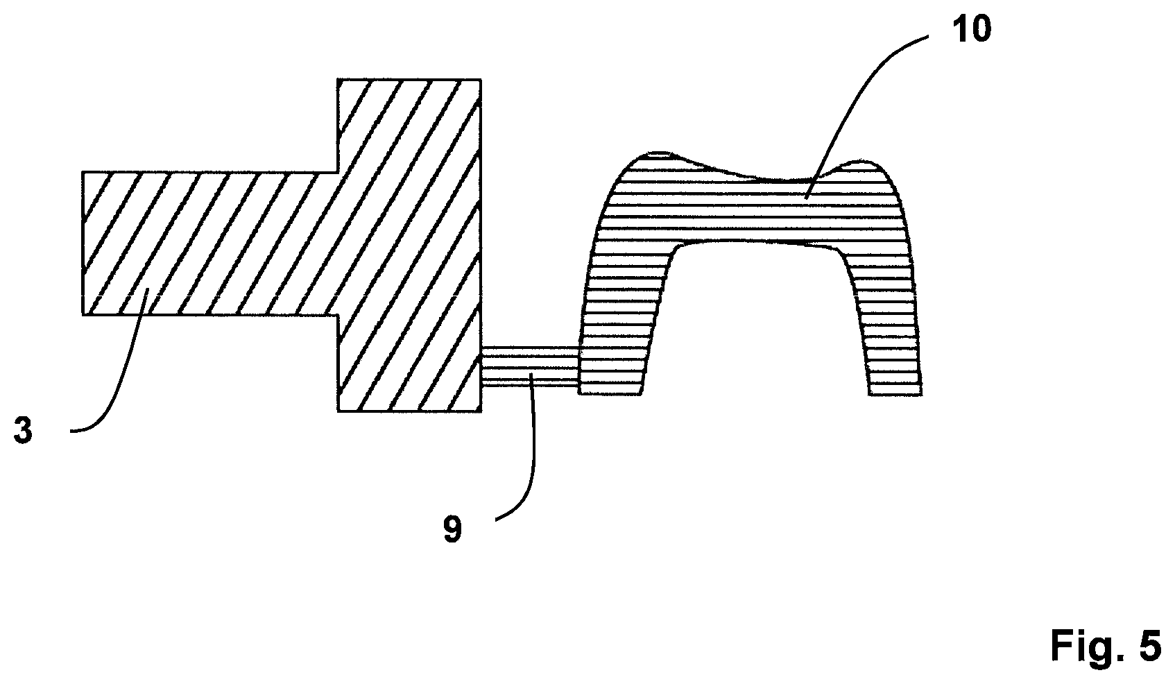 Patent US11771523 Figure 5 – Method for the design and manufacture of a dental component