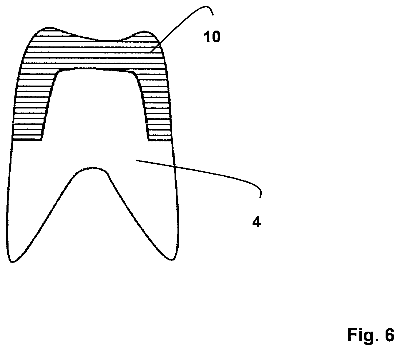 Patent US11771523 Figure 6 – Method for the design and manufacture of a dental component