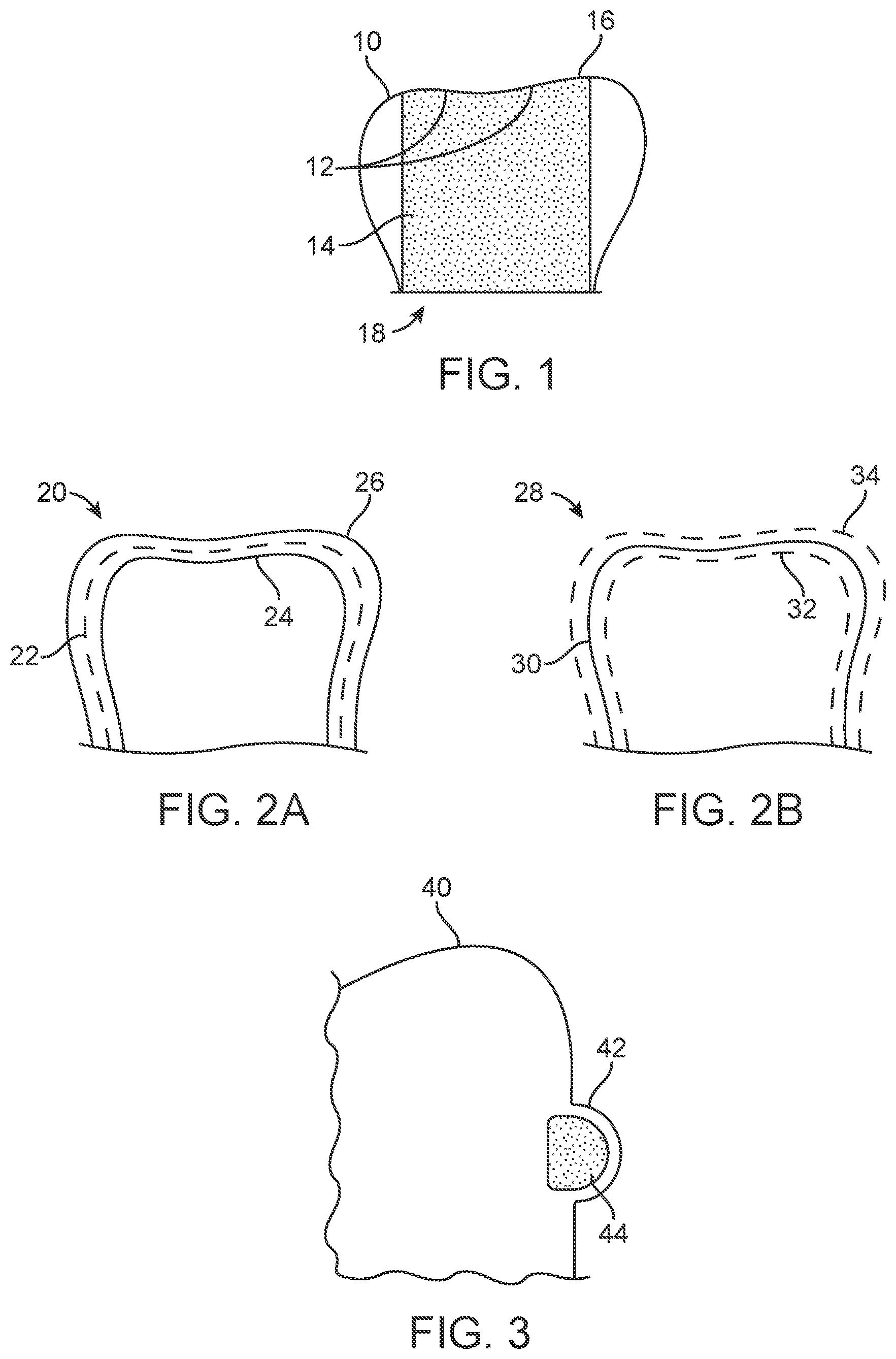 Patent US11771524 Figure 1 – Three-dimensional printed dental appliances using support structures