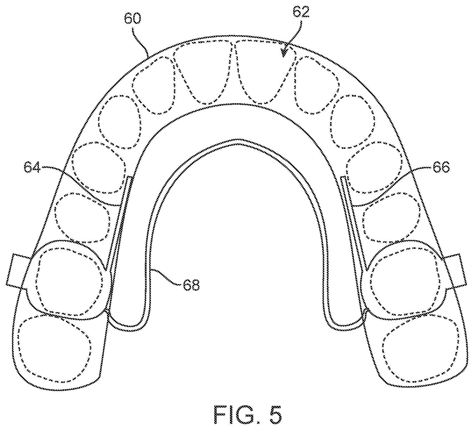 Patent US11771524 Figure 3 – Three-dimensional printed dental appliances using support structures
