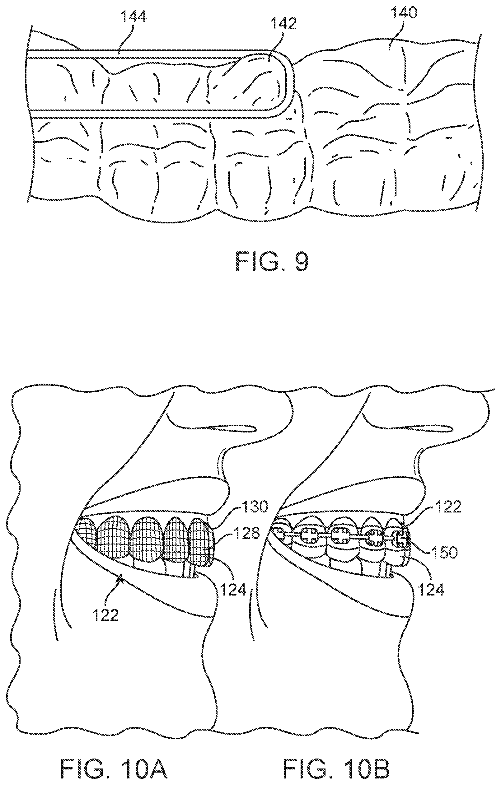 Patent US11771524 Figure 10 – Three-dimensional printed dental appliances using support structures