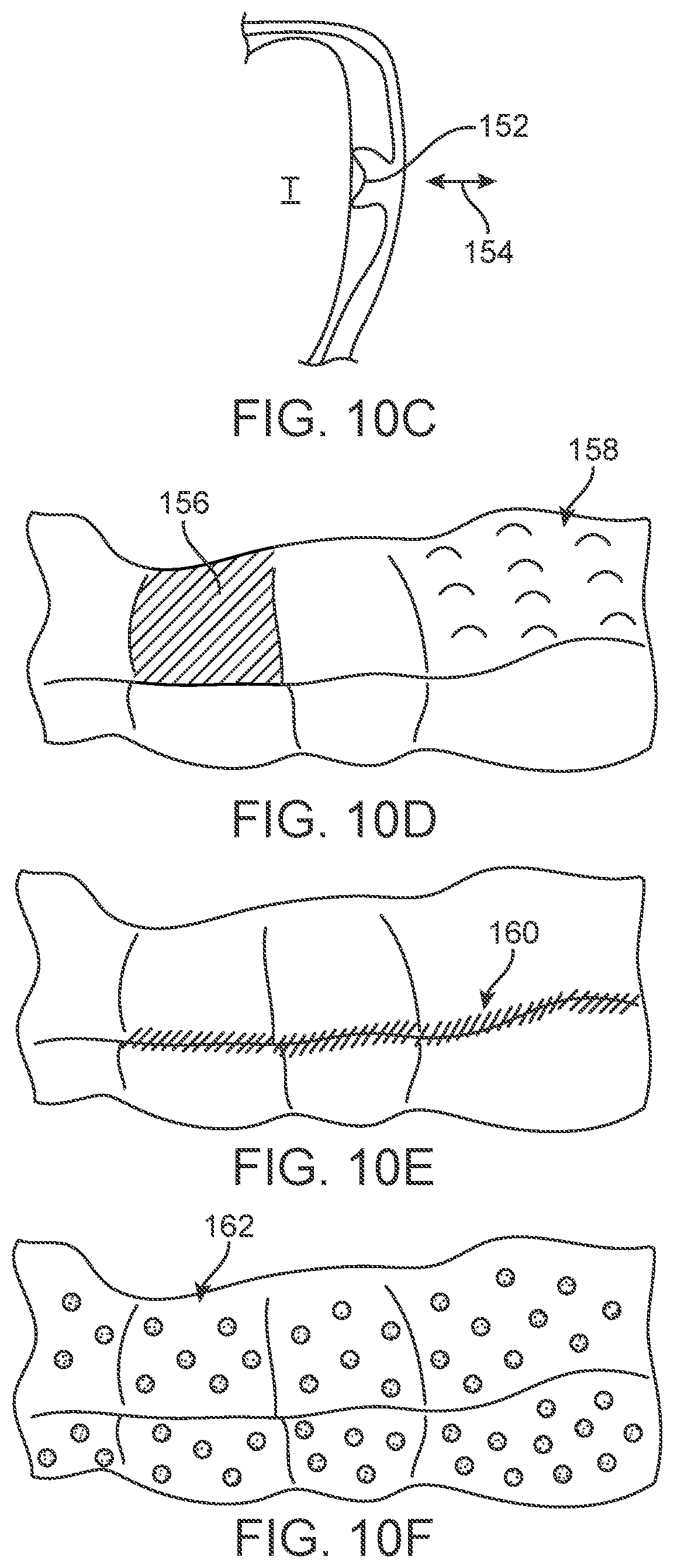 Patent US11771524 Figure 11 – Three-dimensional printed dental appliances using support structures