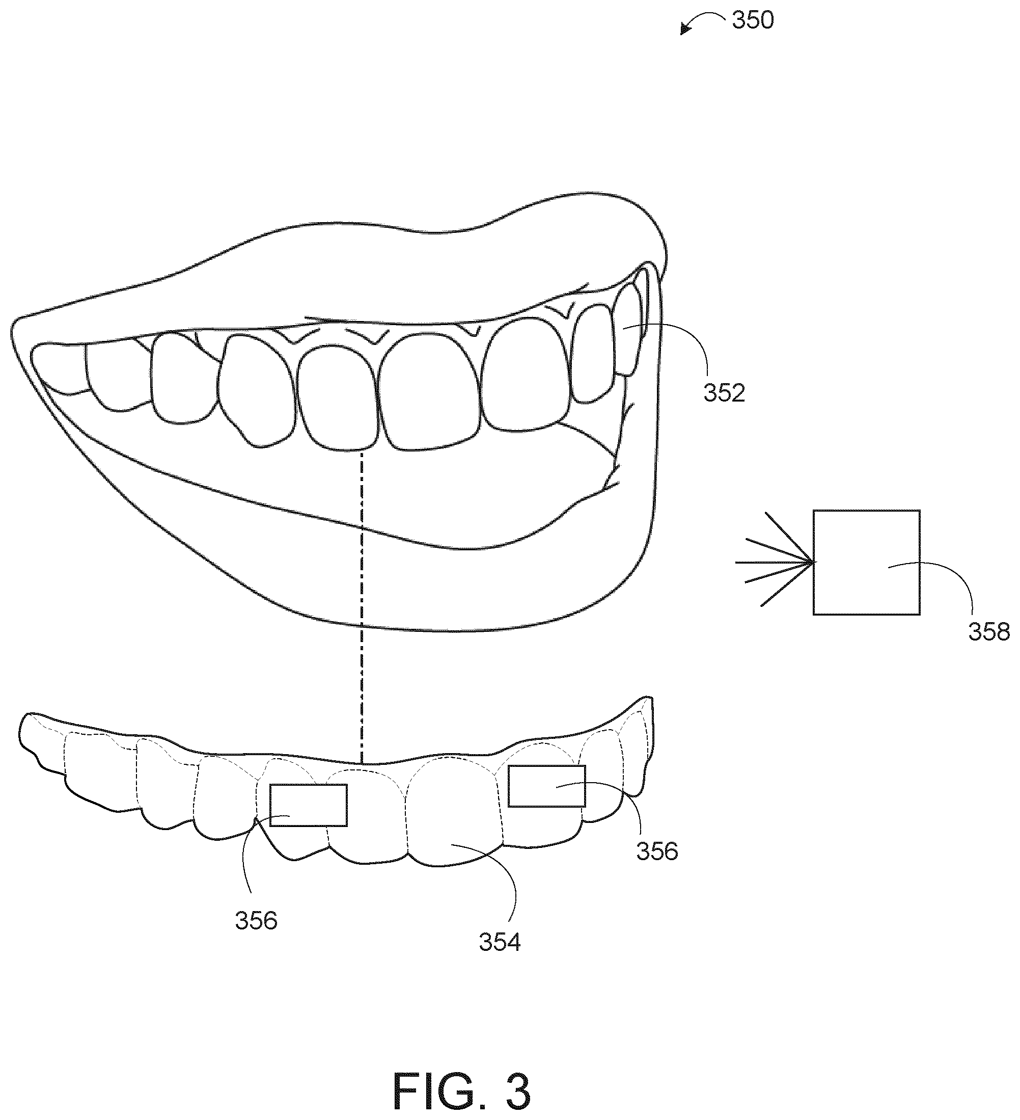 Patent US11771527 Figure 3 – Limited wear aligner and treatment methods