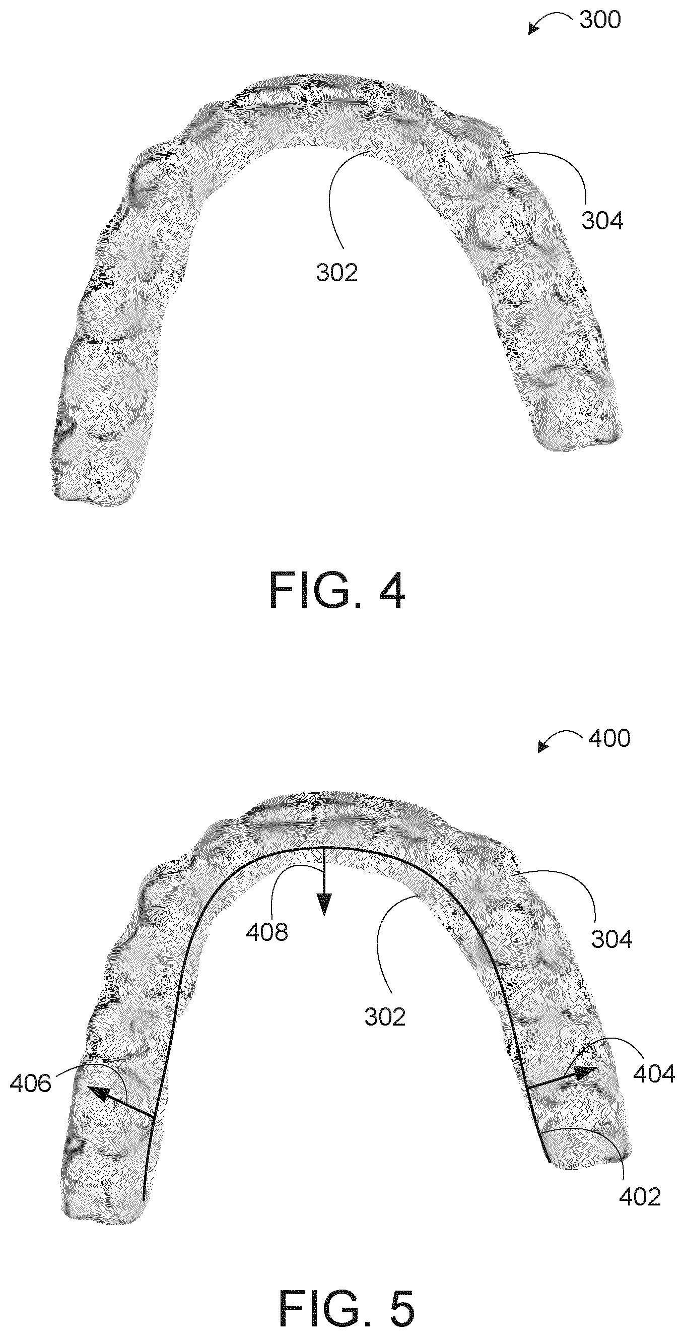 Patent US11771527 Figure 4 – Limited wear aligner and treatment methods