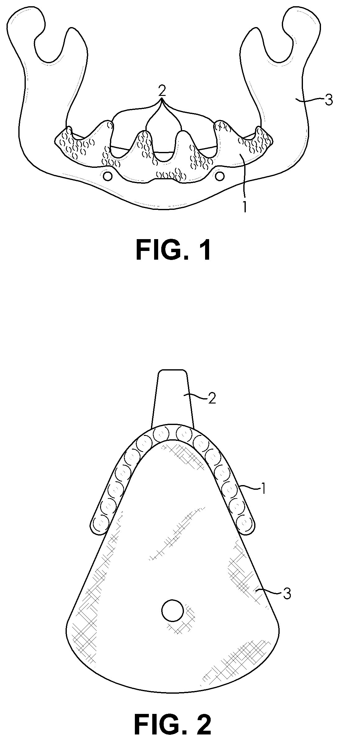 Patent US11771529 Figure 1 – Customized porous supracrestal implant and materials and methods forming them