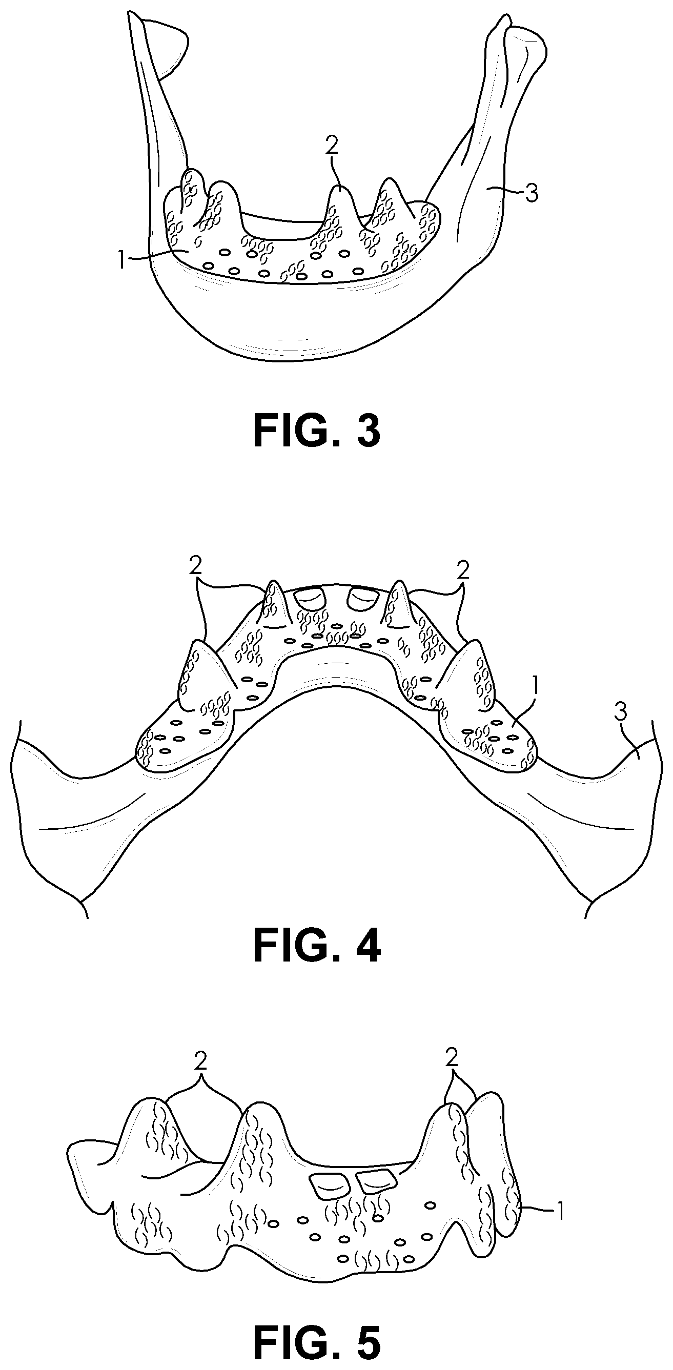 Patent US11771529 Figure 2 – Customized porous supracrestal implant and materials and methods forming them