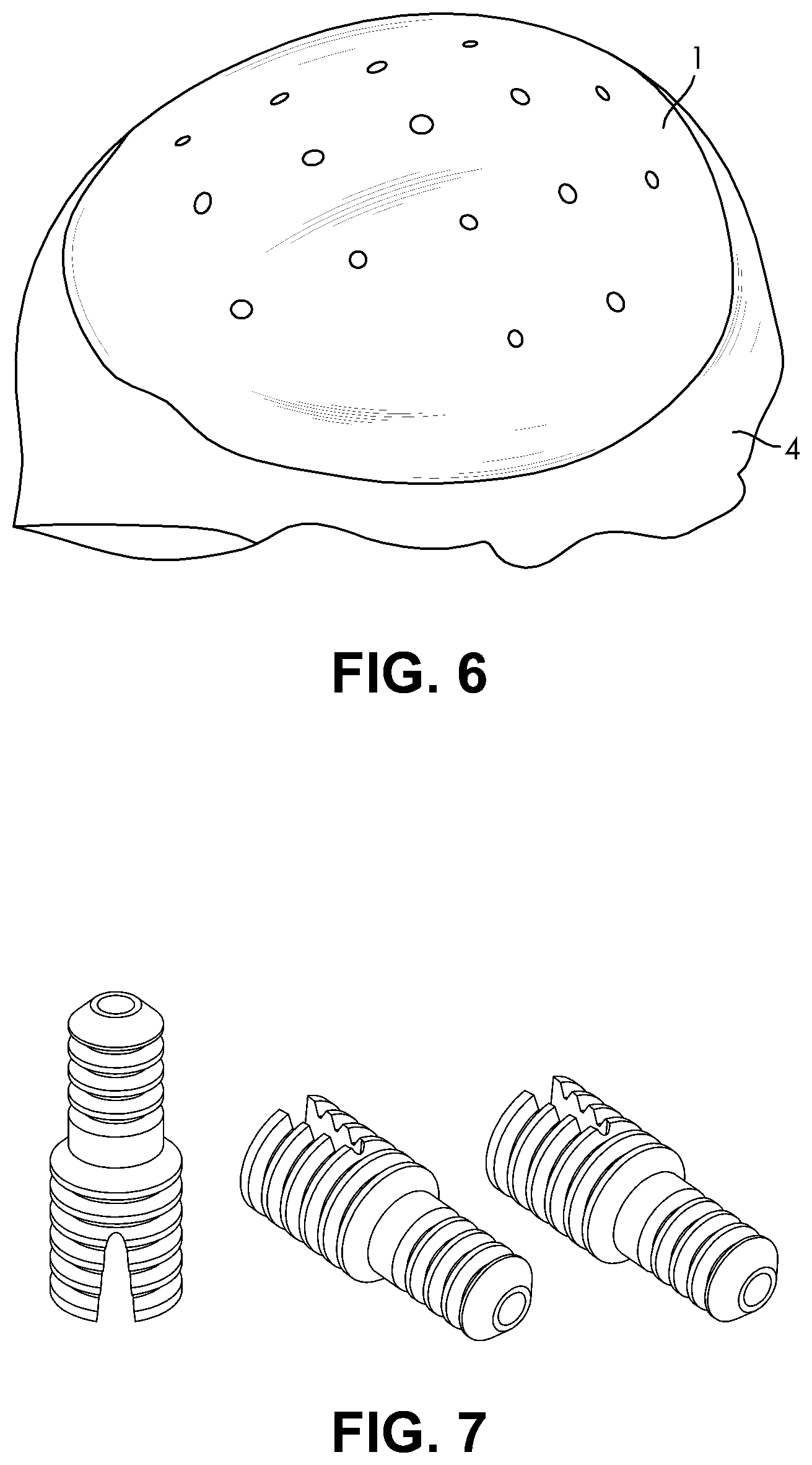 Patent US11771529 Figure 3 – Customized porous supracrestal implant and materials and methods forming them