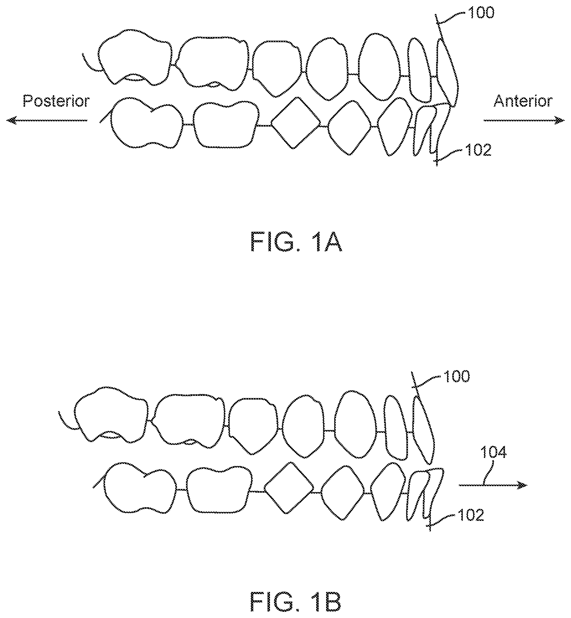 Patent US11771531 — Mandibular advancement and retraction via bone anchoring devices — Figure 1