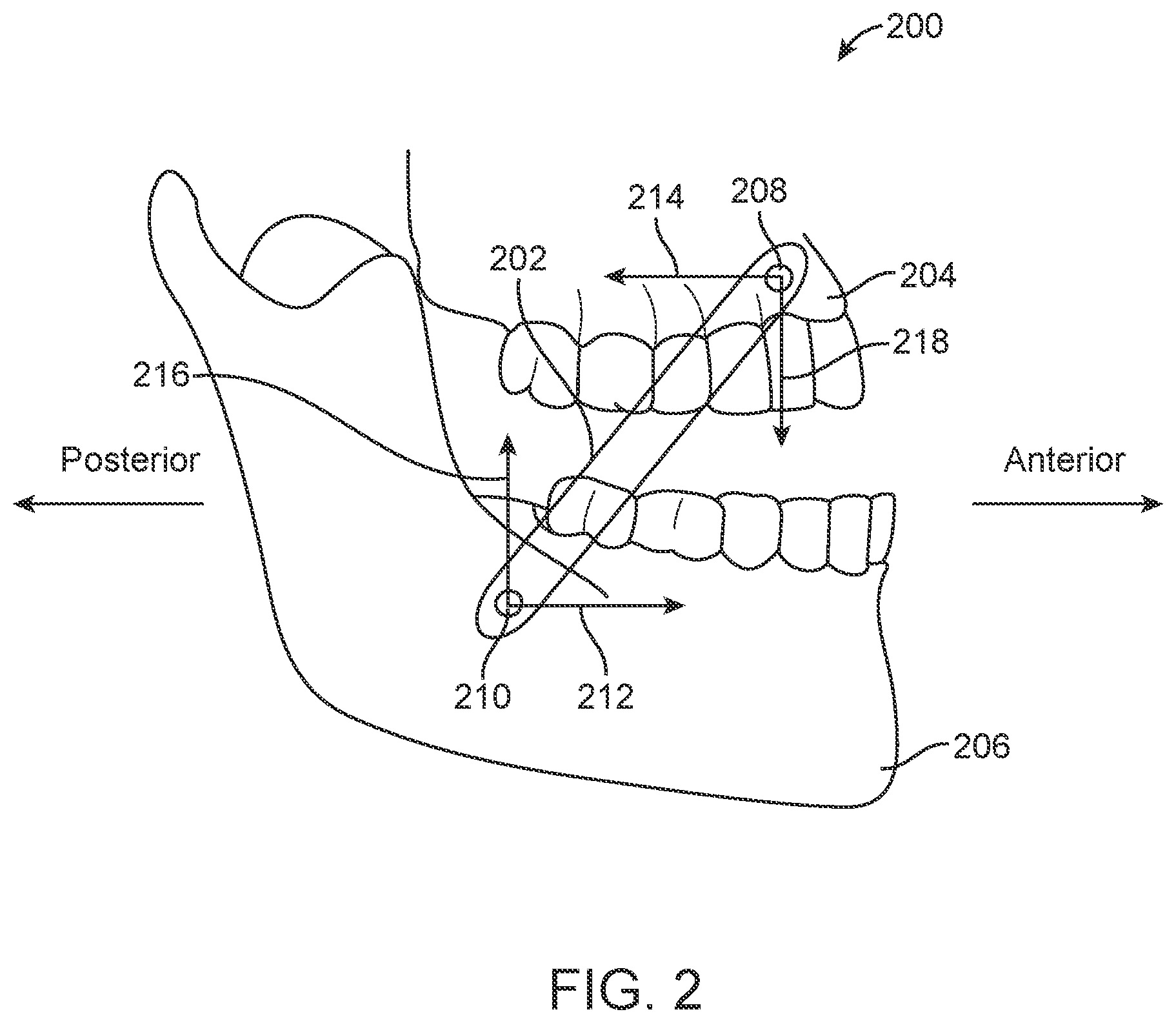 Patent US11771531 Figure 2 – Mandibular advancement and retraction via bone anchoring devices