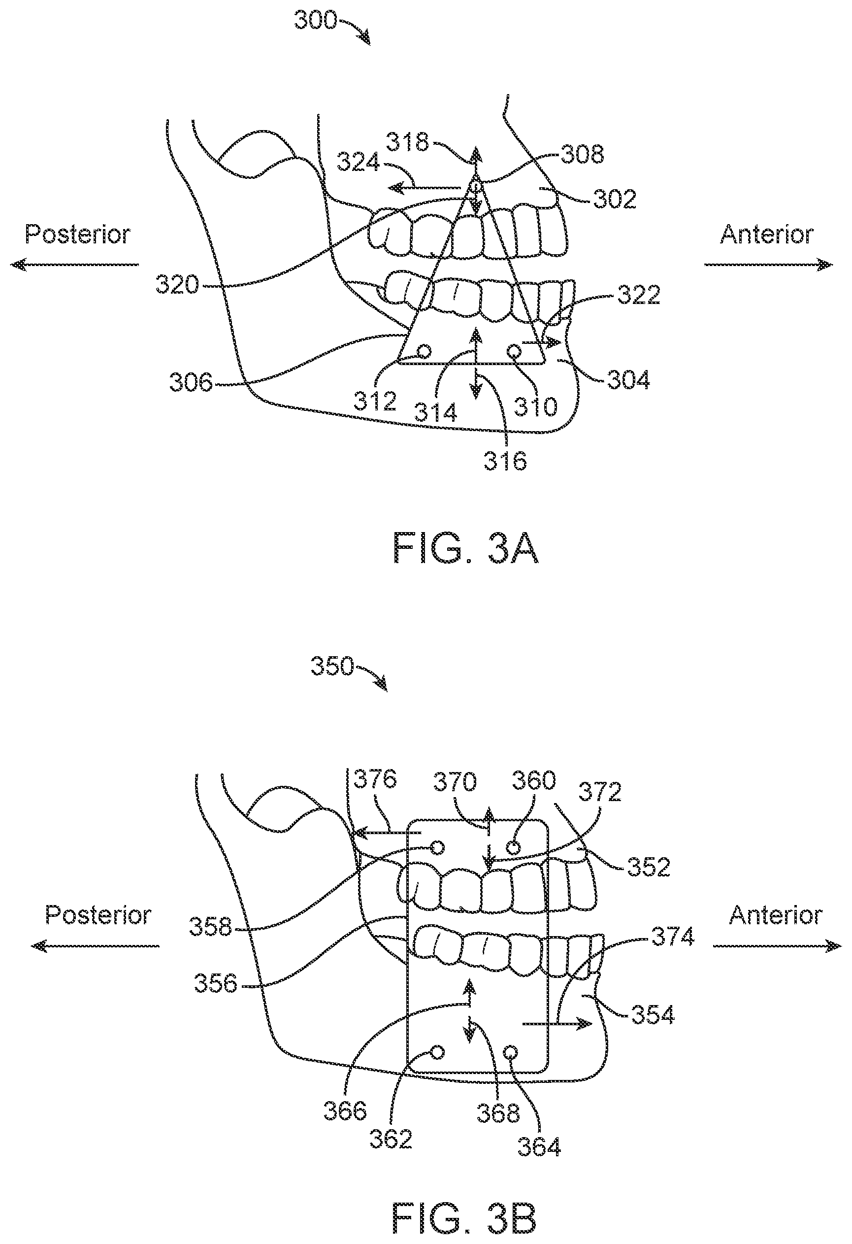 Patent US11771531 Figure 3 – Mandibular advancement and retraction via bone anchoring devices