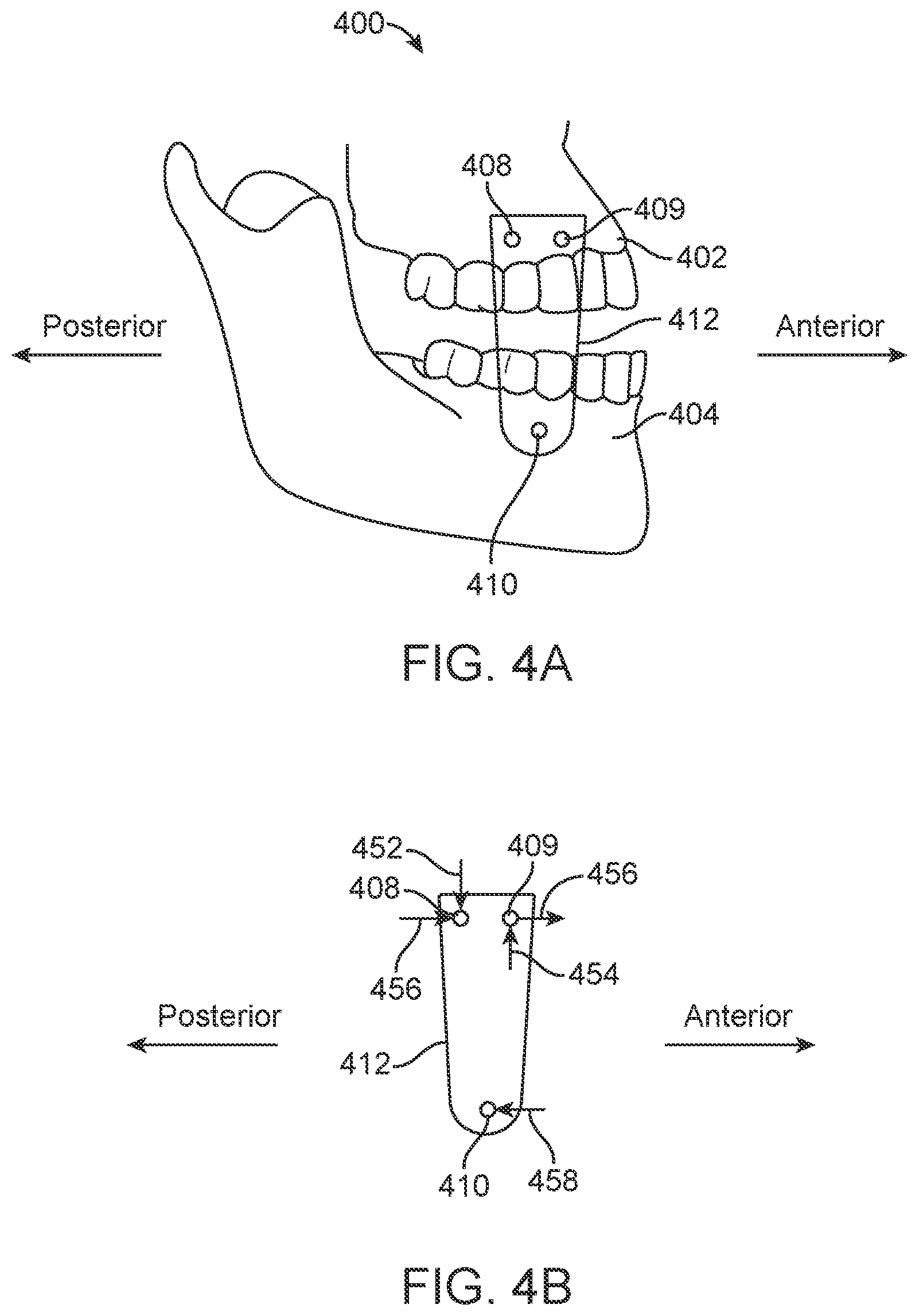 Patent US11771531 Figure 4 – Mandibular advancement and retraction via bone anchoring devices