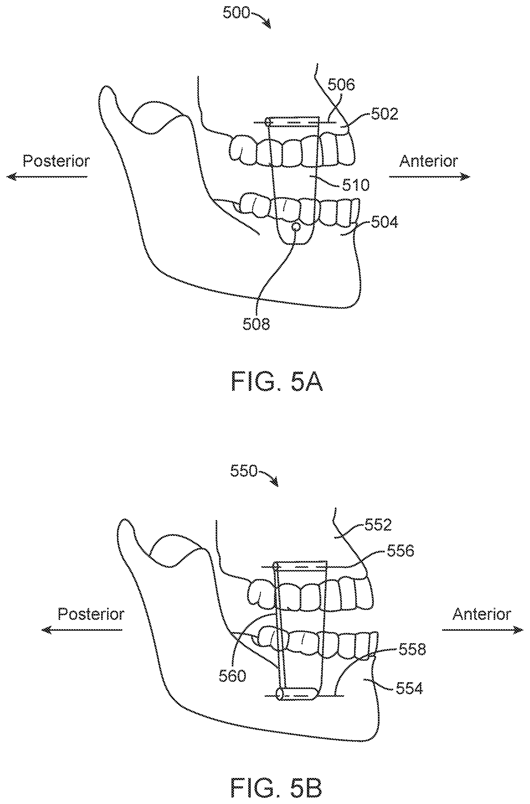 Patent US11771531 Figure 5 – Mandibular advancement and retraction via bone anchoring devices