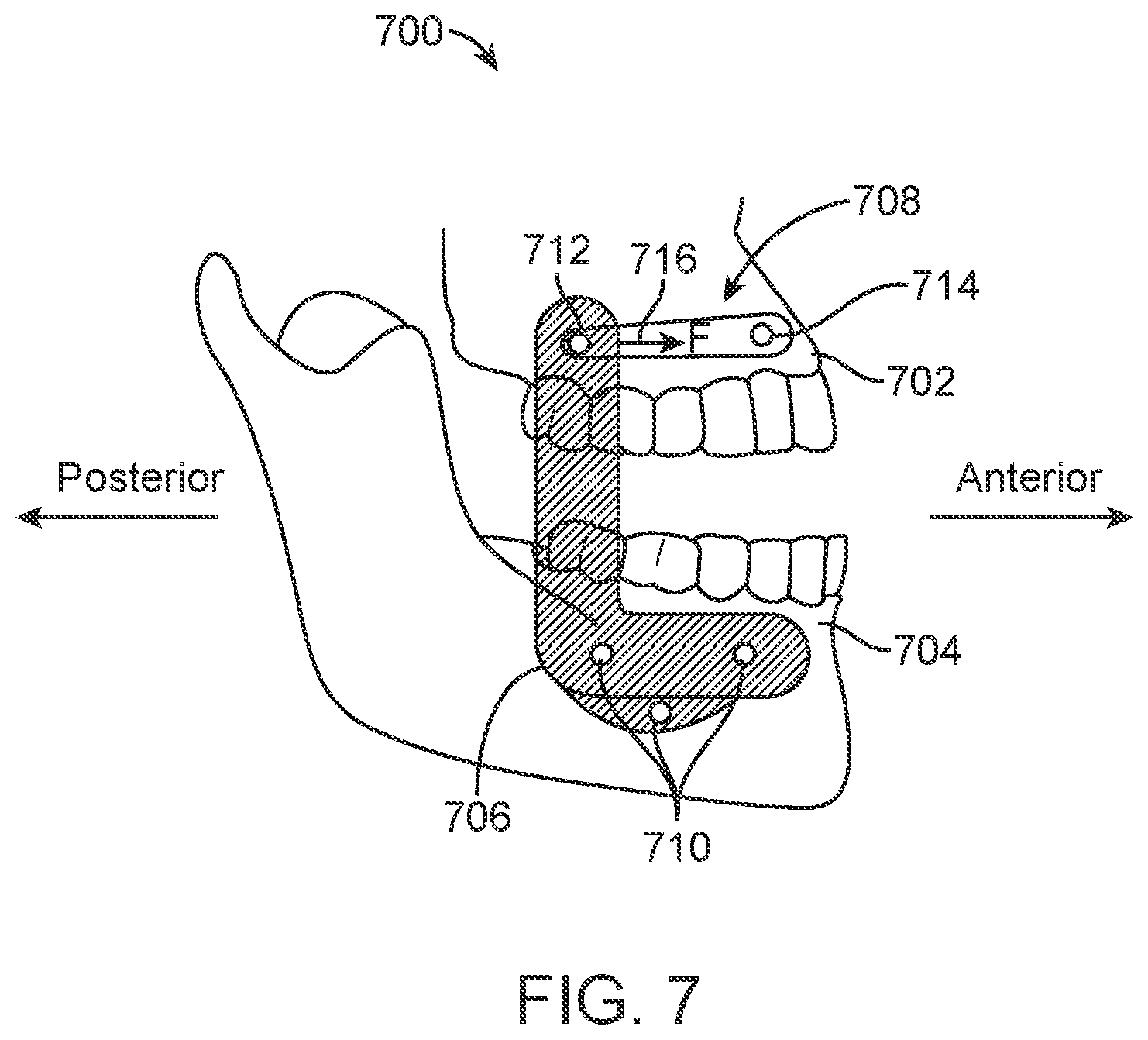 Patent US11771531 Figure 7 – Mandibular advancement and retraction via bone anchoring devices
