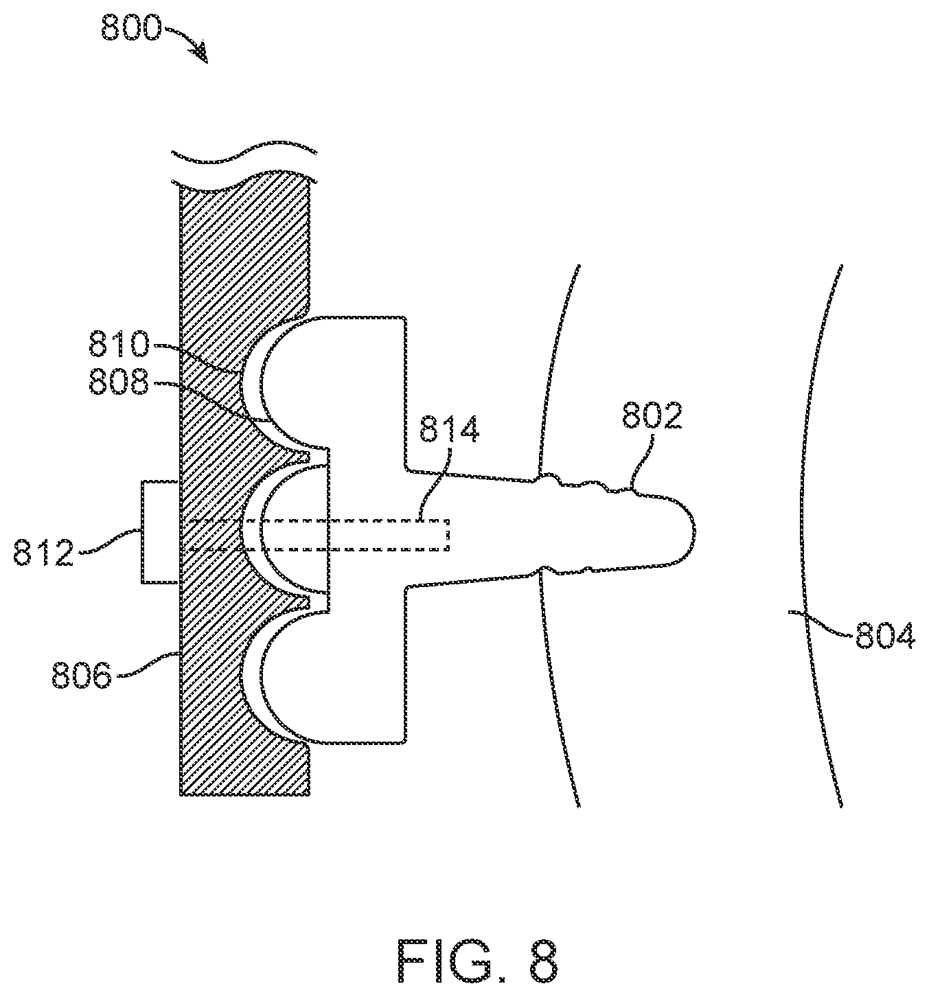 Patent US11771531 Figure 8 – Mandibular advancement and retraction via bone anchoring devices