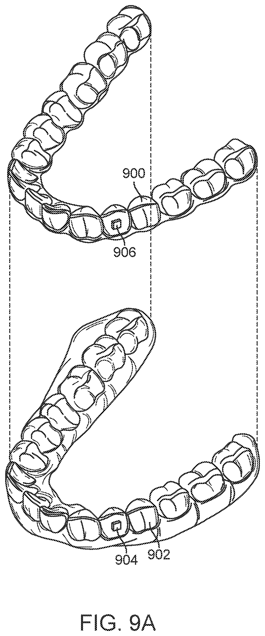 Patent US11771531 Figure 9 – Mandibular advancement and retraction via bone anchoring devices