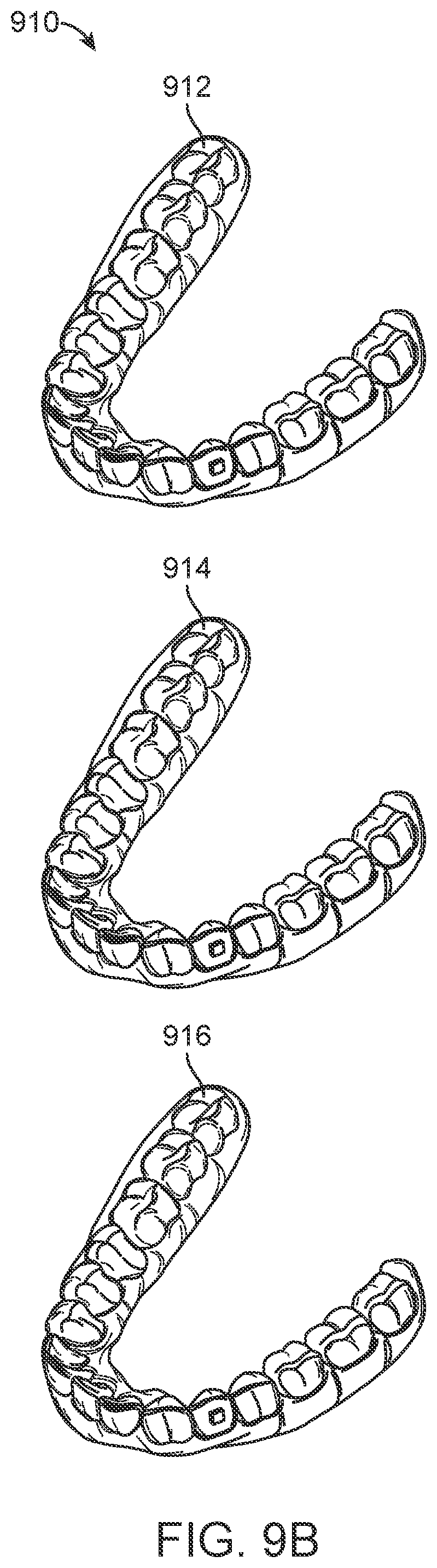 Patent US11771531 Figure 10 – Mandibular advancement and retraction via bone anchoring devices