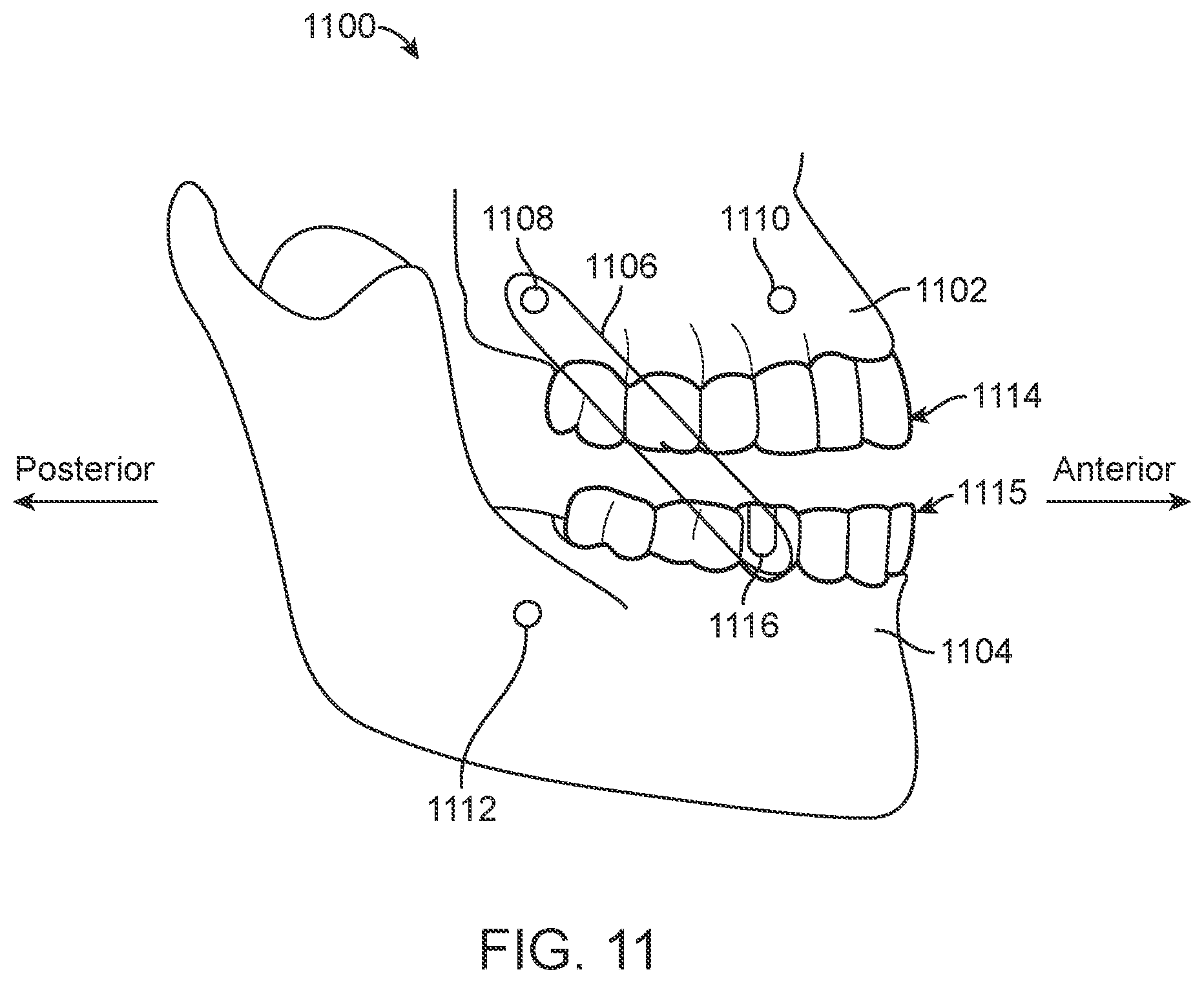 Patent US11771531 Figure 12 – Mandibular advancement and retraction via bone anchoring devices