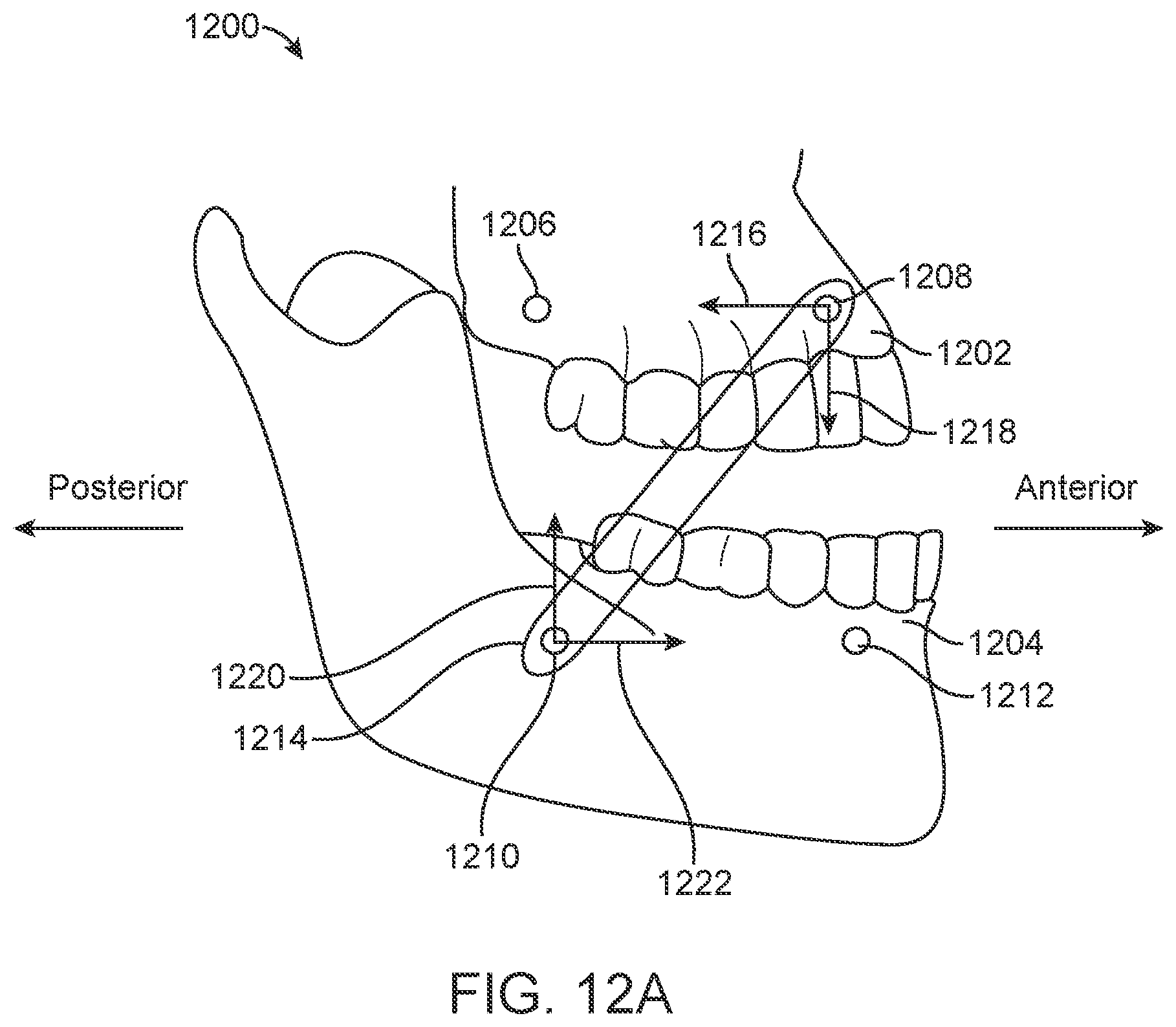 Patent US11771531 Figure 13 – Mandibular advancement and retraction via bone anchoring devices