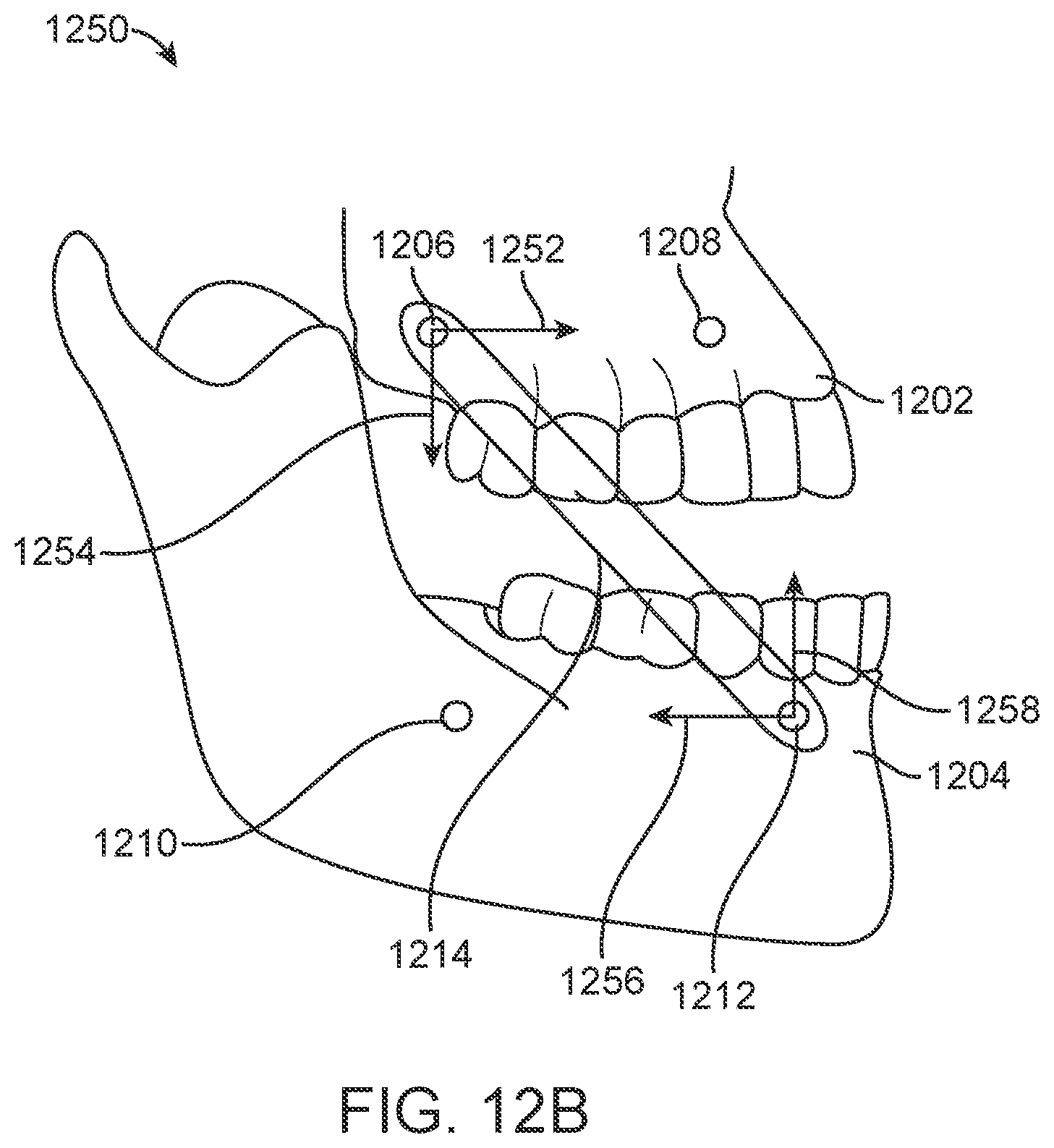 Patent US11771531 Figure 14 – Mandibular advancement and retraction via bone anchoring devices