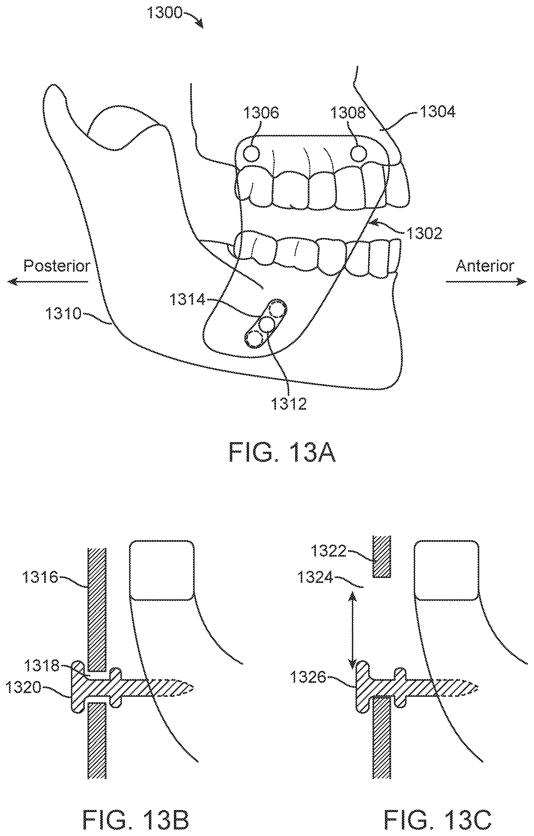 Patent US11771531 Figure 15 – Mandibular advancement and retraction via bone anchoring devices