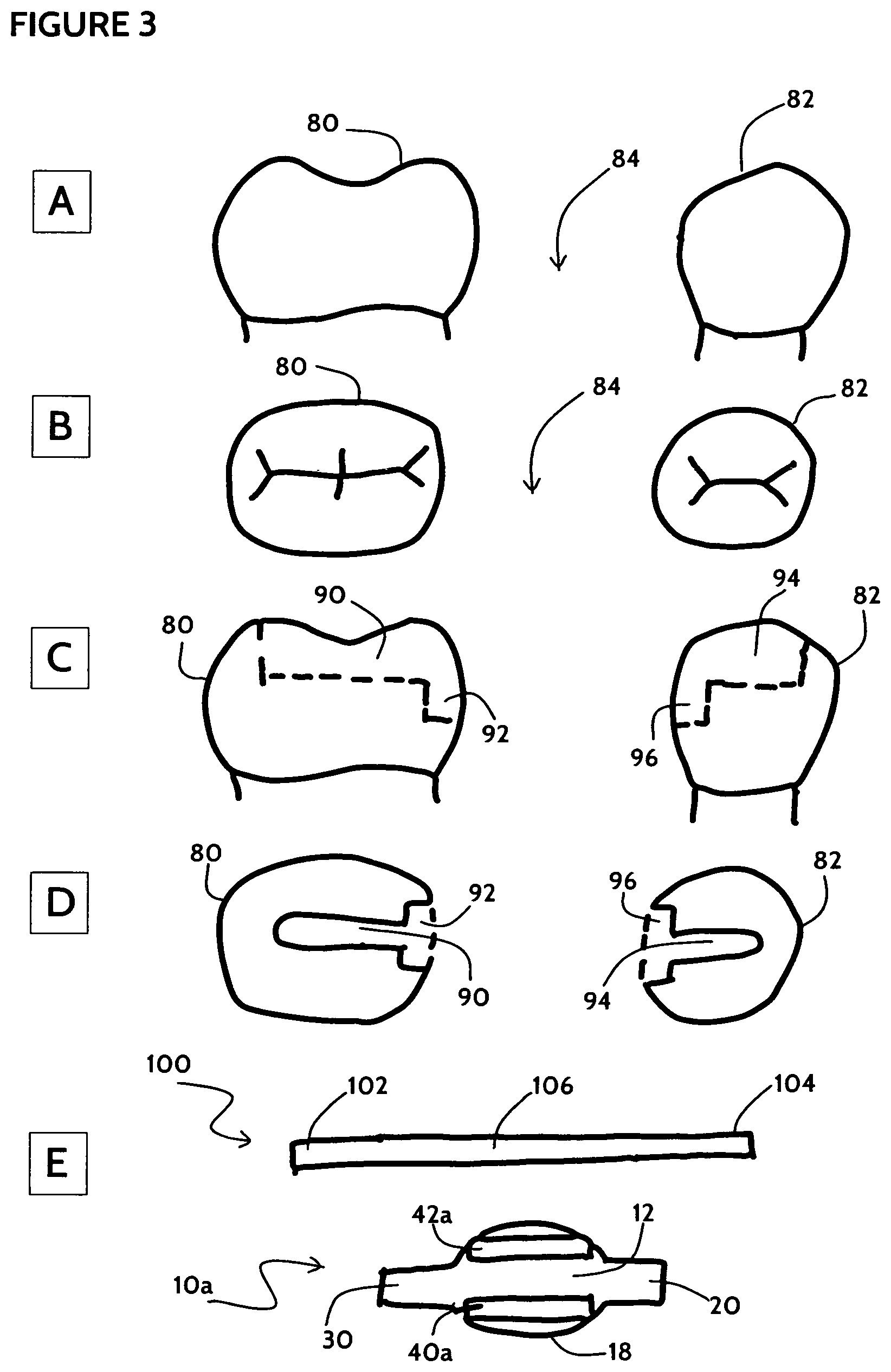 Patent US11771532 Figure 3 – Direct dental bridge