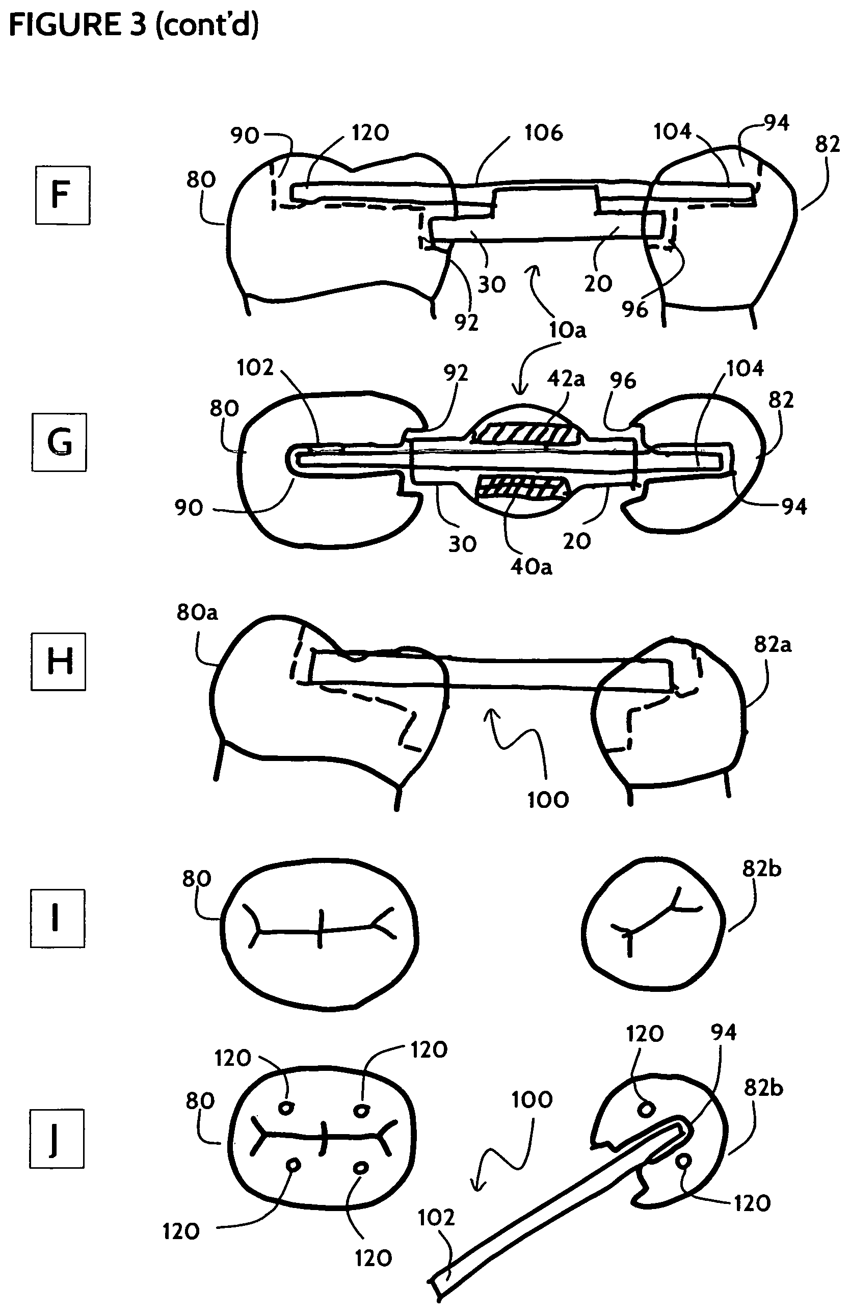 Patent US11771532 Figure 4 – Direct dental bridge