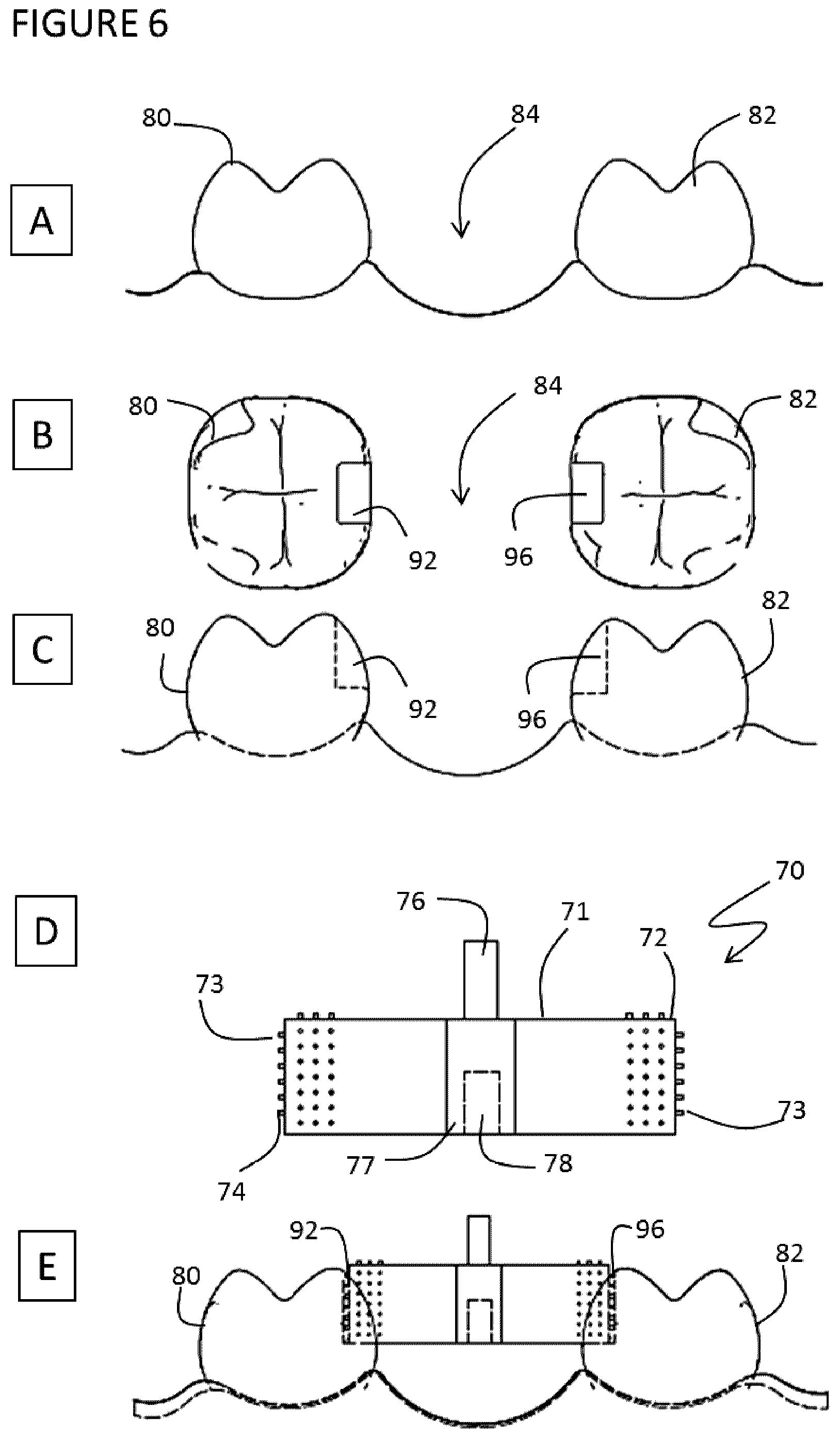 Patent US11771532 Figure 9 – Direct dental bridge