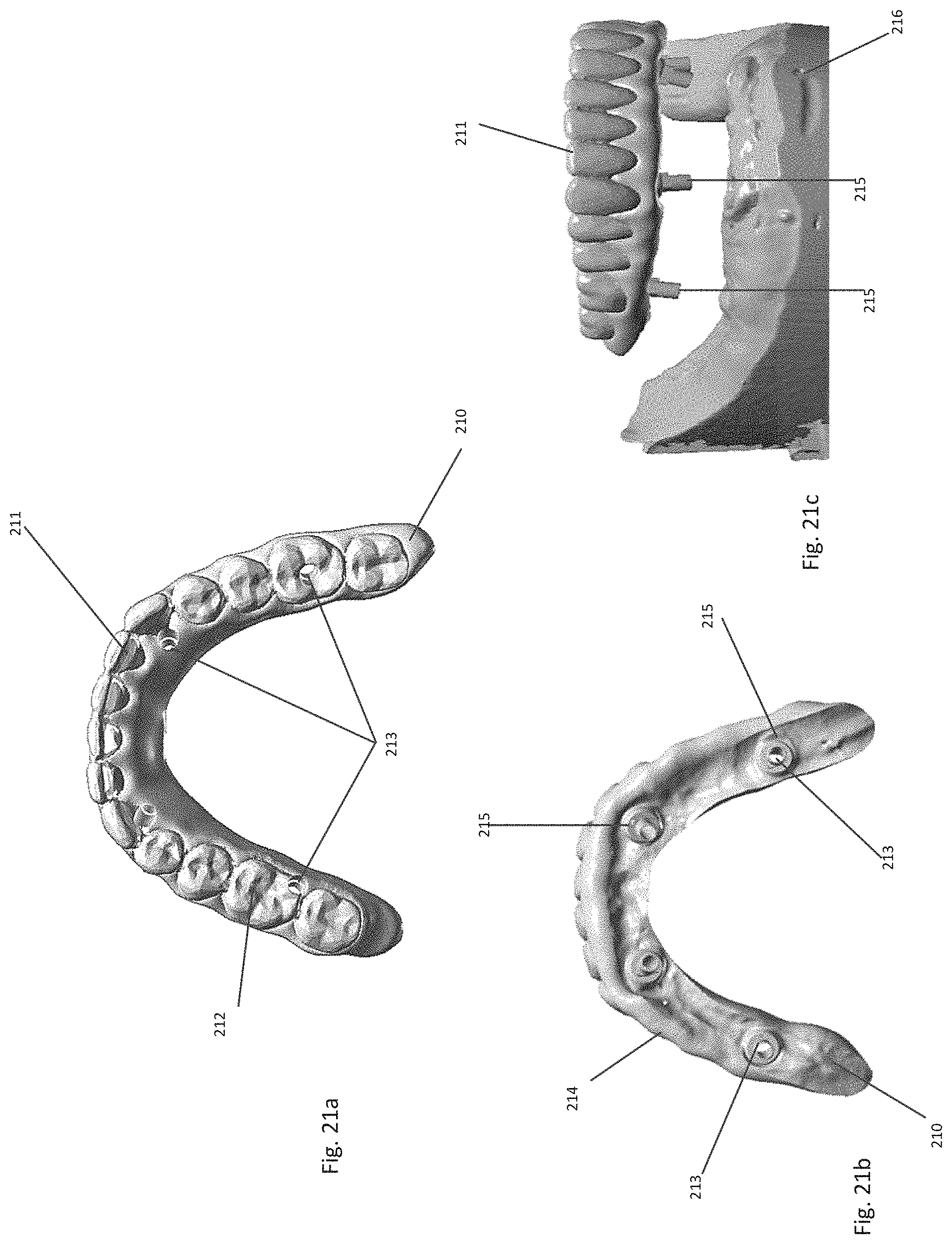 Patent US11771535 Figure 17 – Apparatus and methods of making denture devices