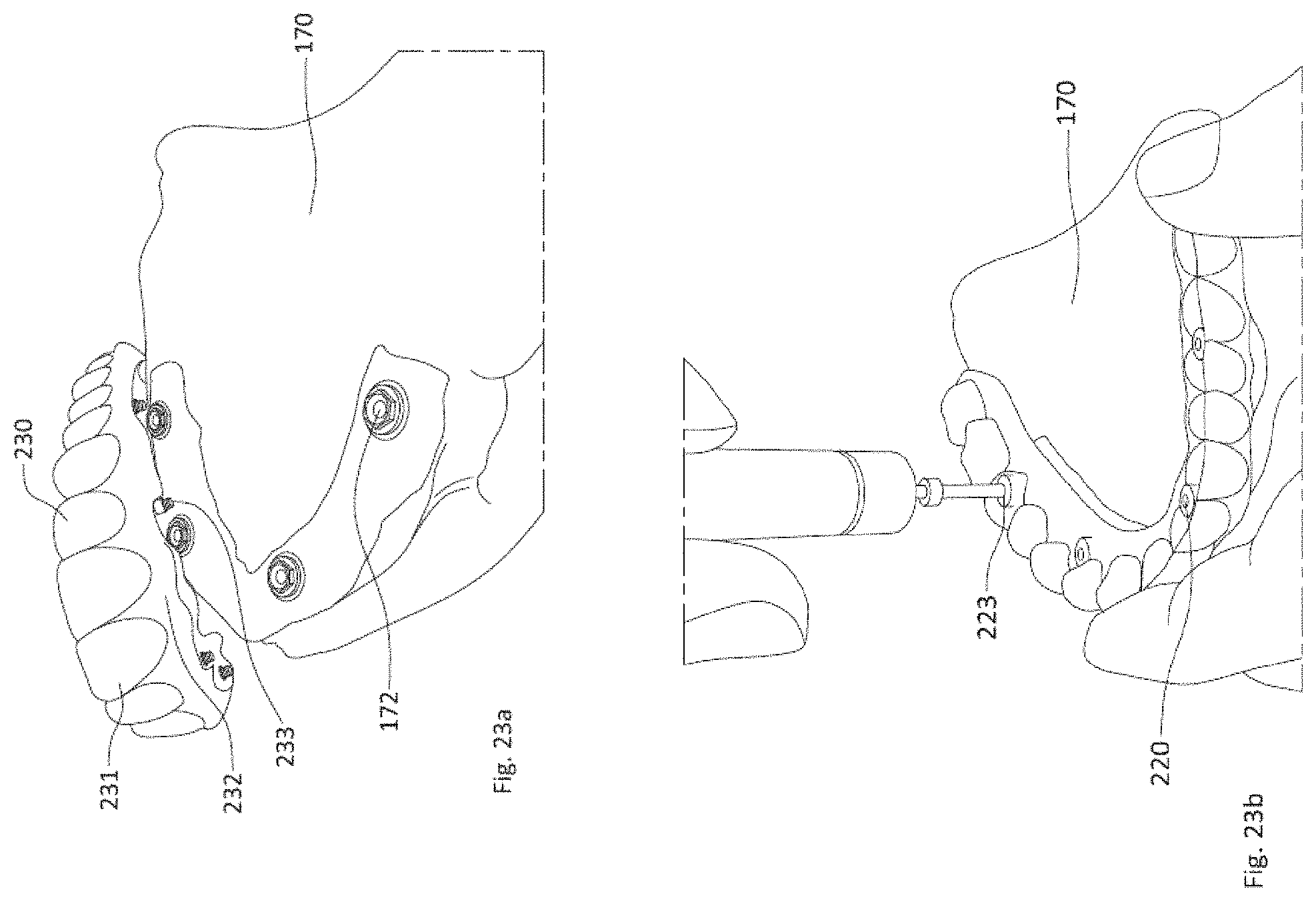 Patent US11771535 Figure 19 – Apparatus and methods of making denture devices
