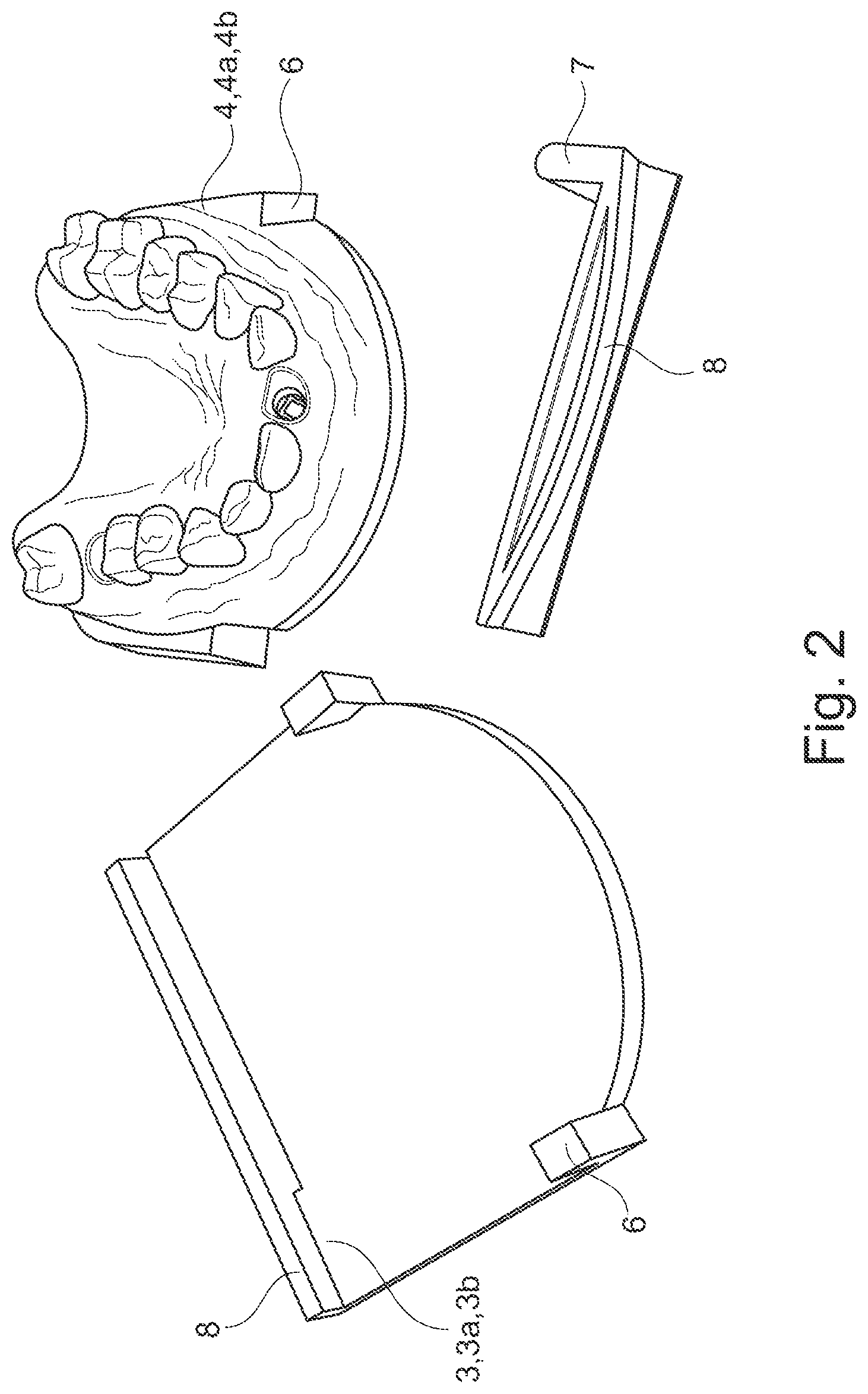 Patent US11771536 Figure 2 – Method for producing a dental working model