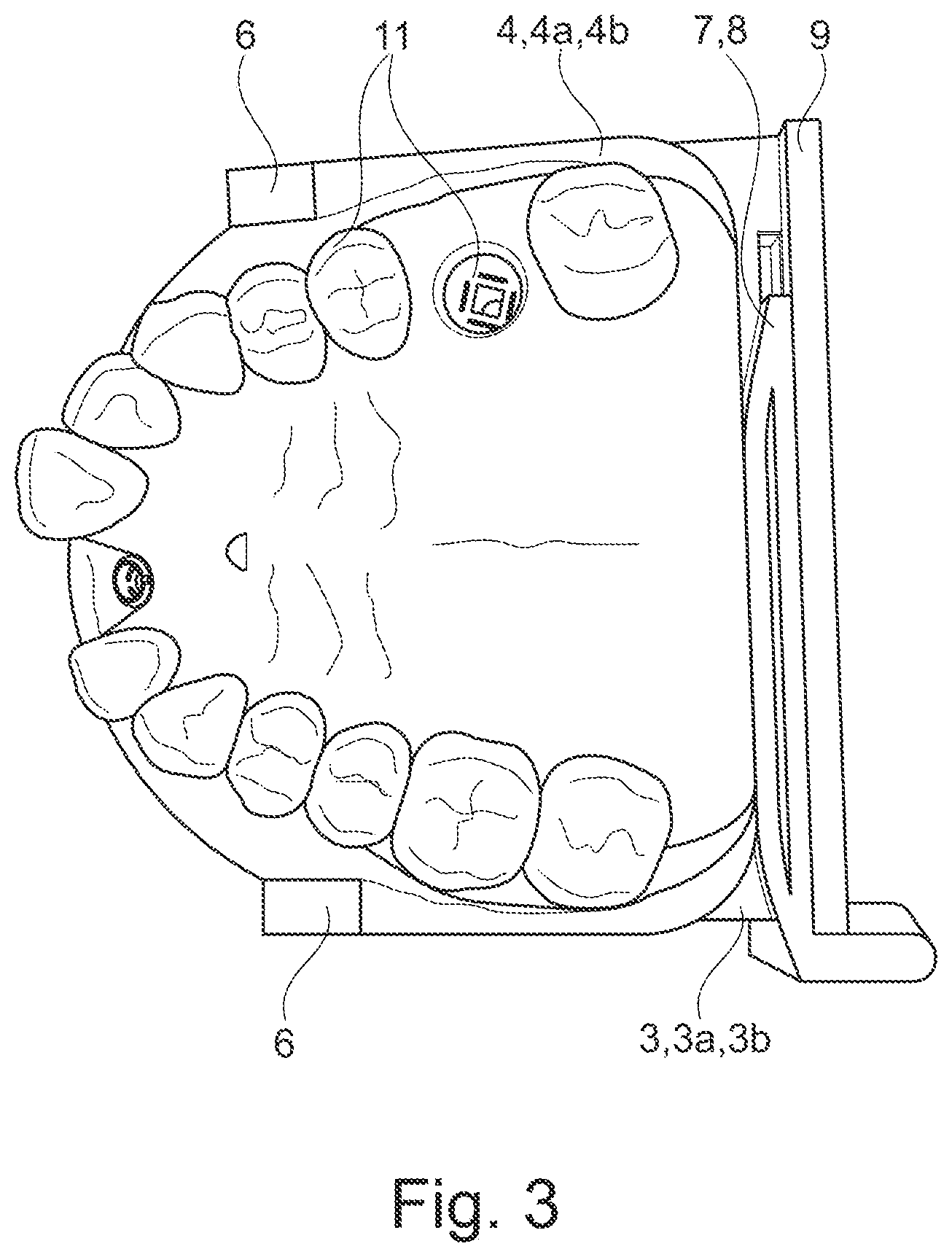 Patent US11771536 Figure 3 – Method for producing a dental working model