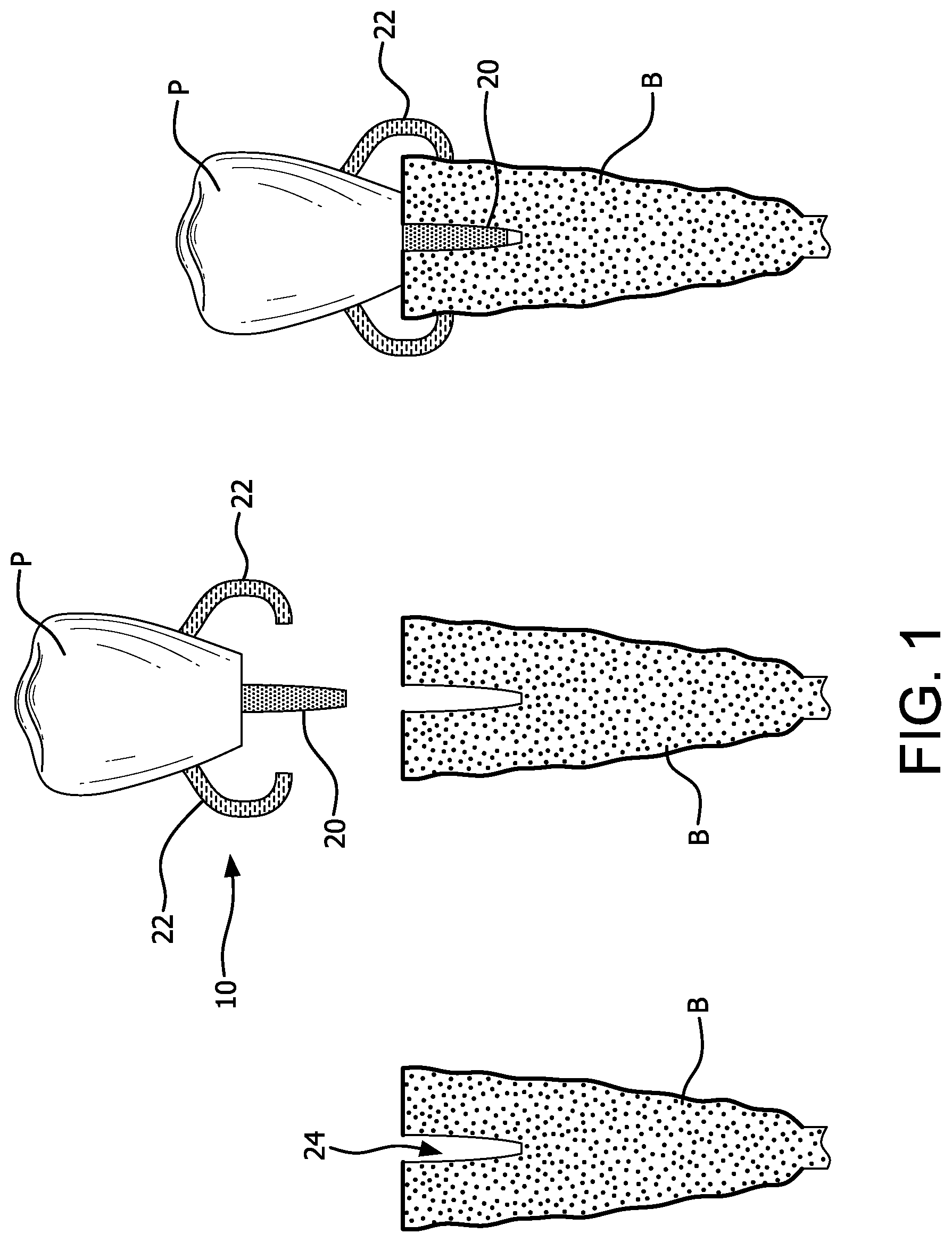 Patent US11771537 Figure 1 – MElHOD for dynamically guiding a dental oral and maxillofacial prosthesis