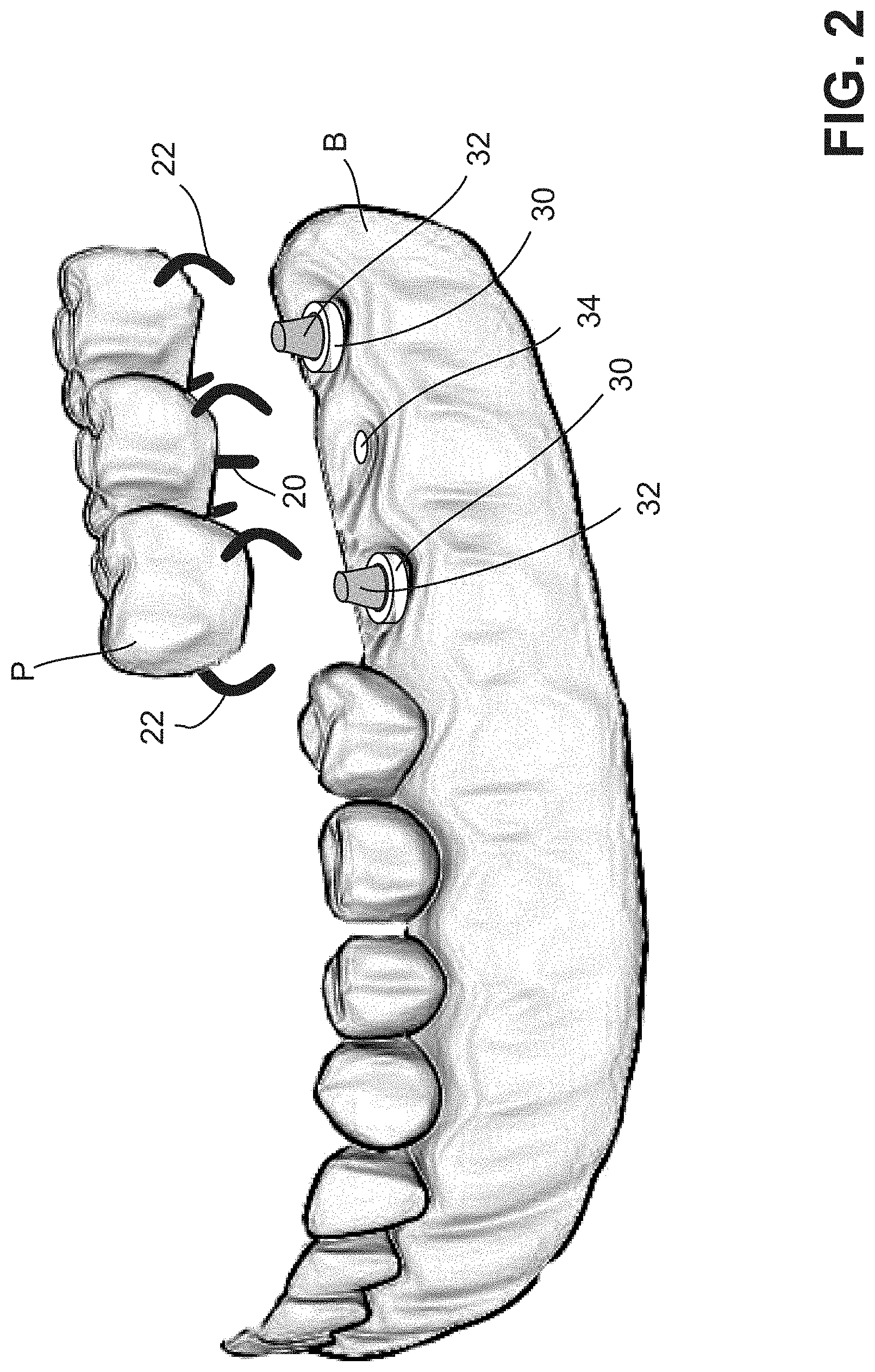 Patent US11771537 Figure 2 – MElHOD for dynamically guiding a dental oral and maxillofacial prosthesis