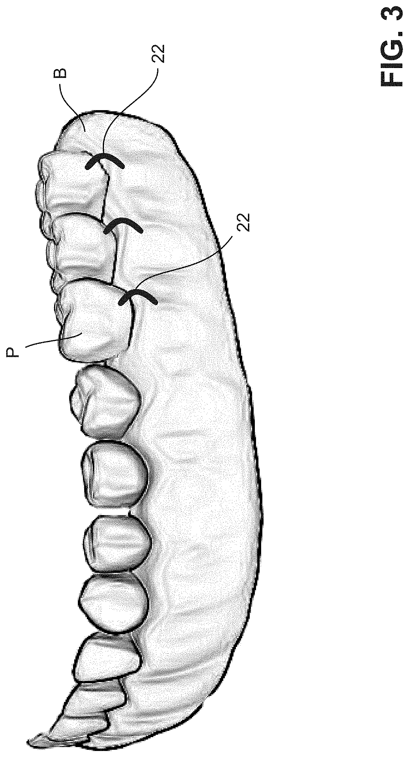 Patent US11771537 Figure 3 – MElHOD for dynamically guiding a dental oral and maxillofacial prosthesis