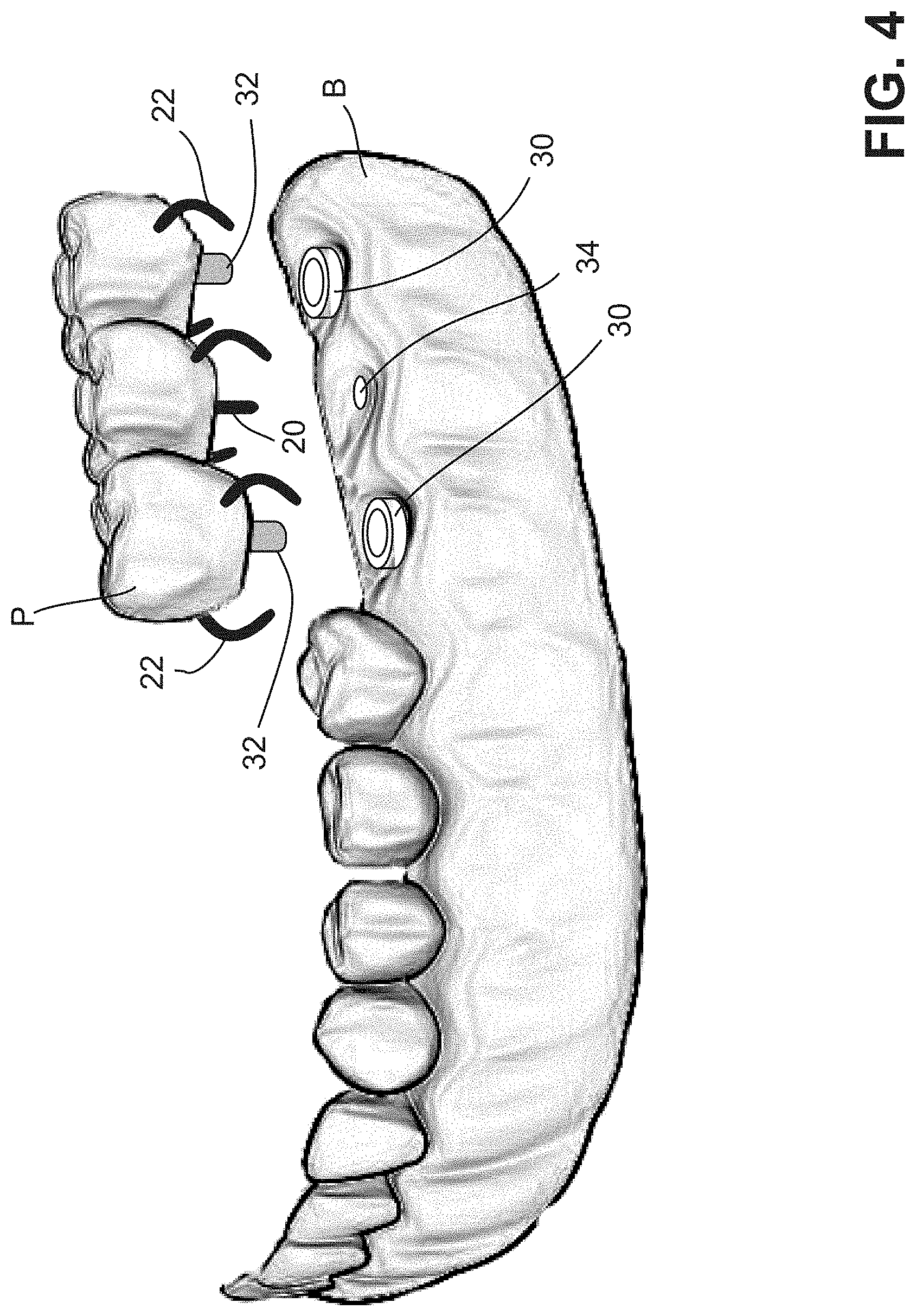 Patent US11771537 Figure 4 – MElHOD for dynamically guiding a dental oral and maxillofacial prosthesis