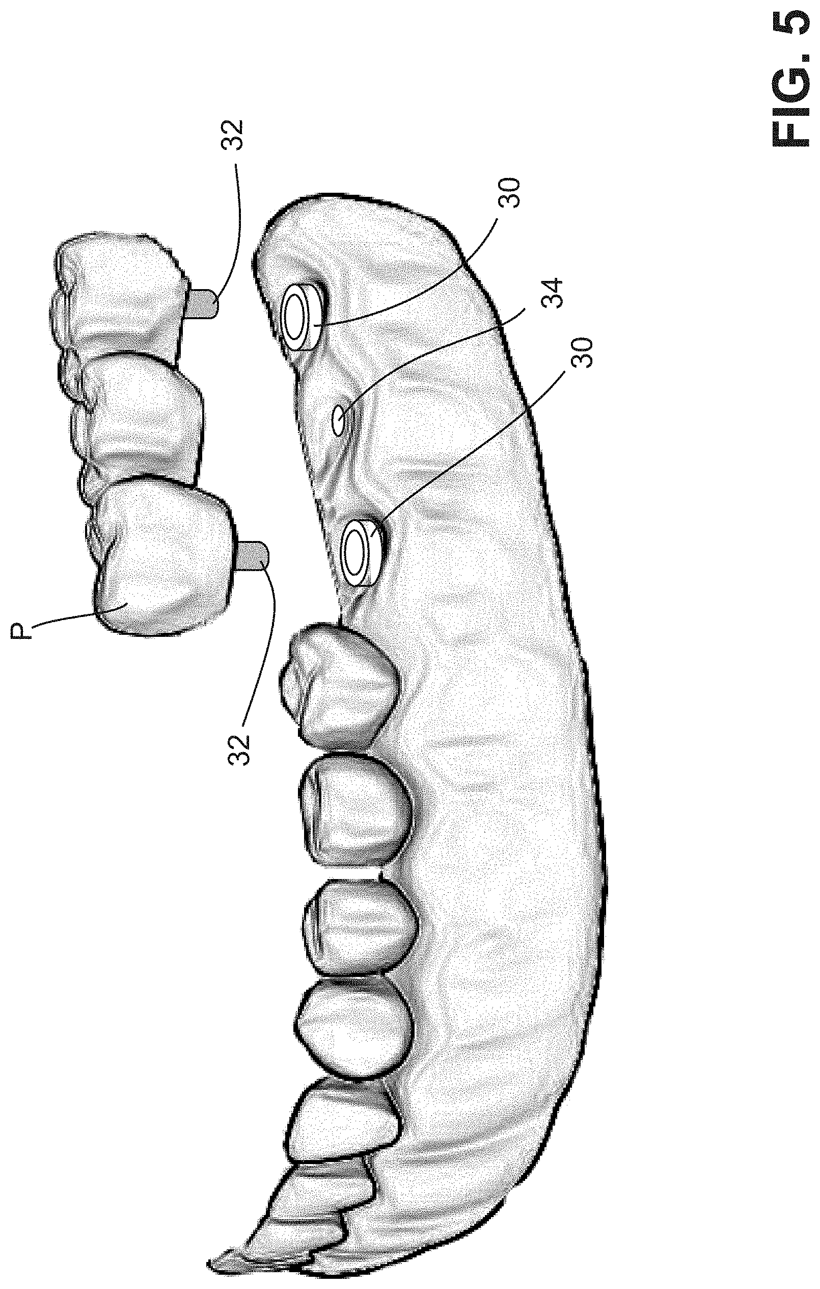 Patent US11771537 Figure 5 – MElHOD for dynamically guiding a dental oral and maxillofacial prosthesis