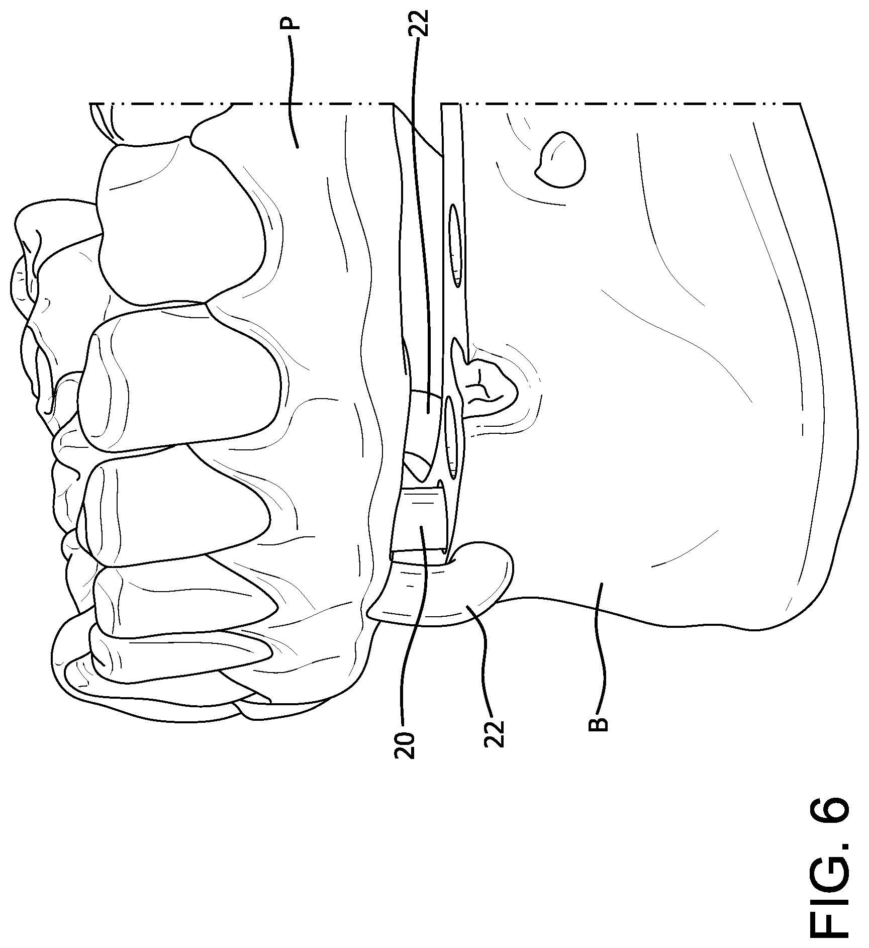 Patent US11771537 Figure 6 – MElHOD for dynamically guiding a dental oral and maxillofacial prosthesis