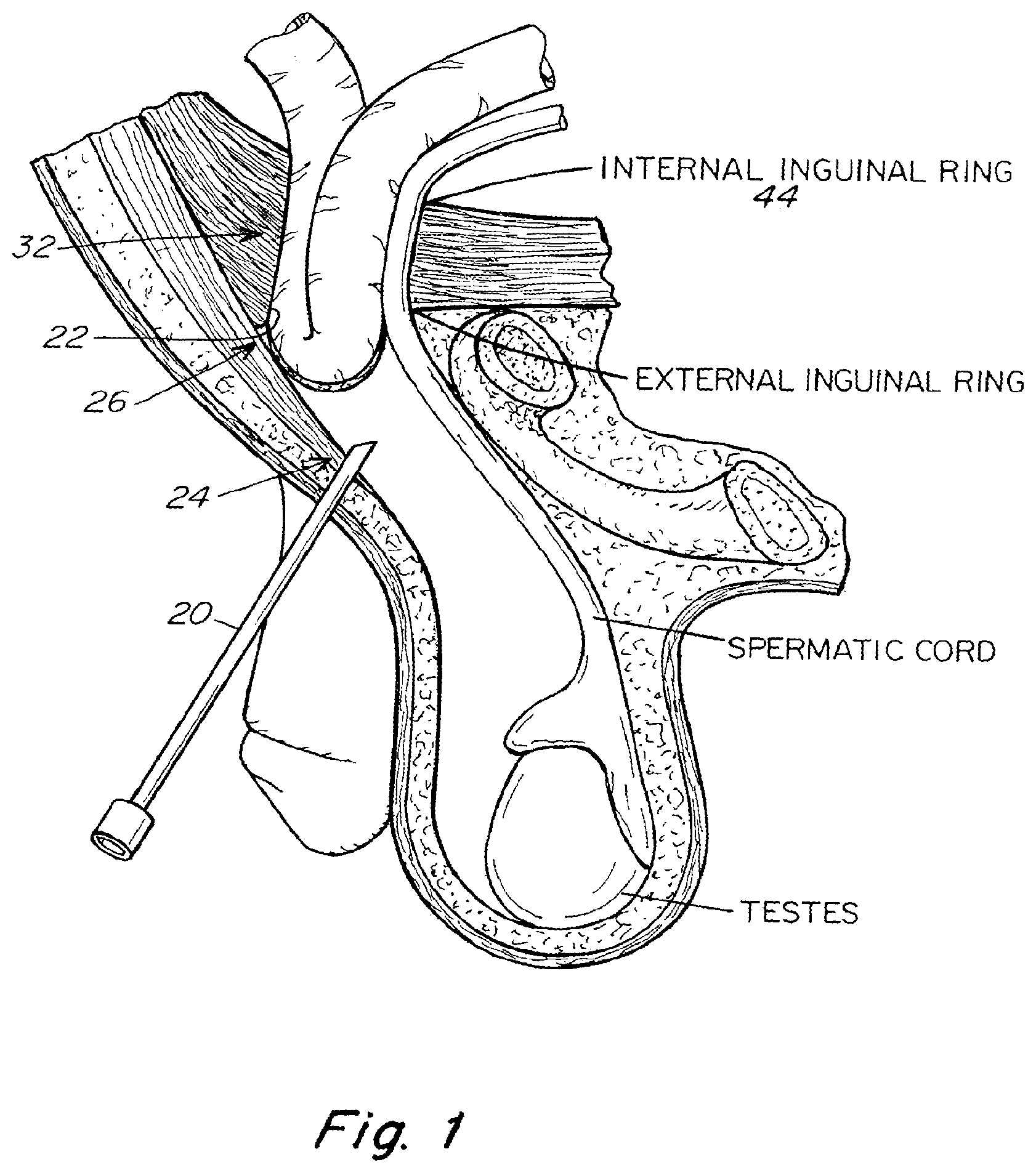 Patent US11771542 Figure 1 – Method and prosthesis for percutaneous hernia repair