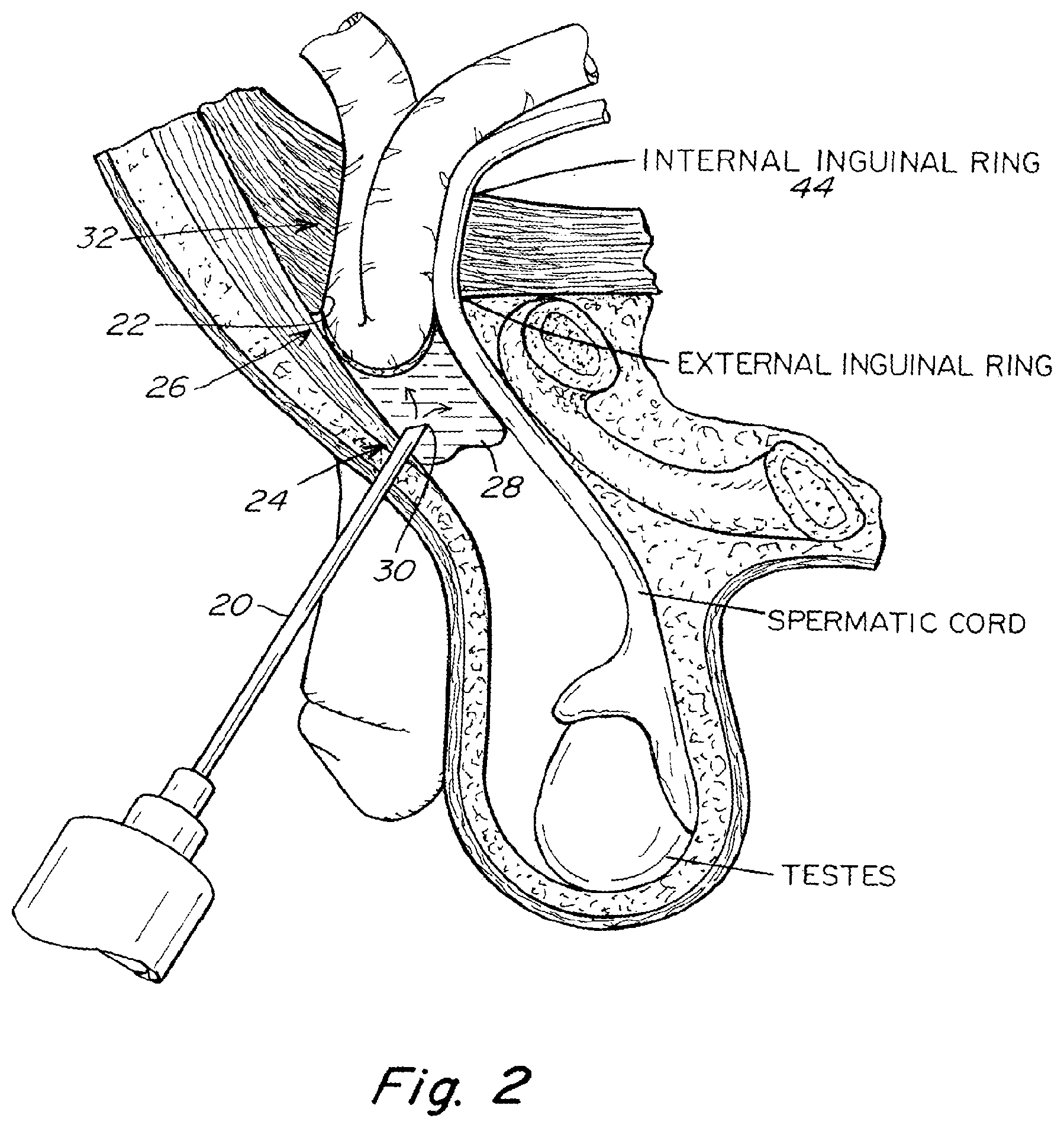Patent US11771542 Figure 2 – Method and prosthesis for percutaneous hernia repair