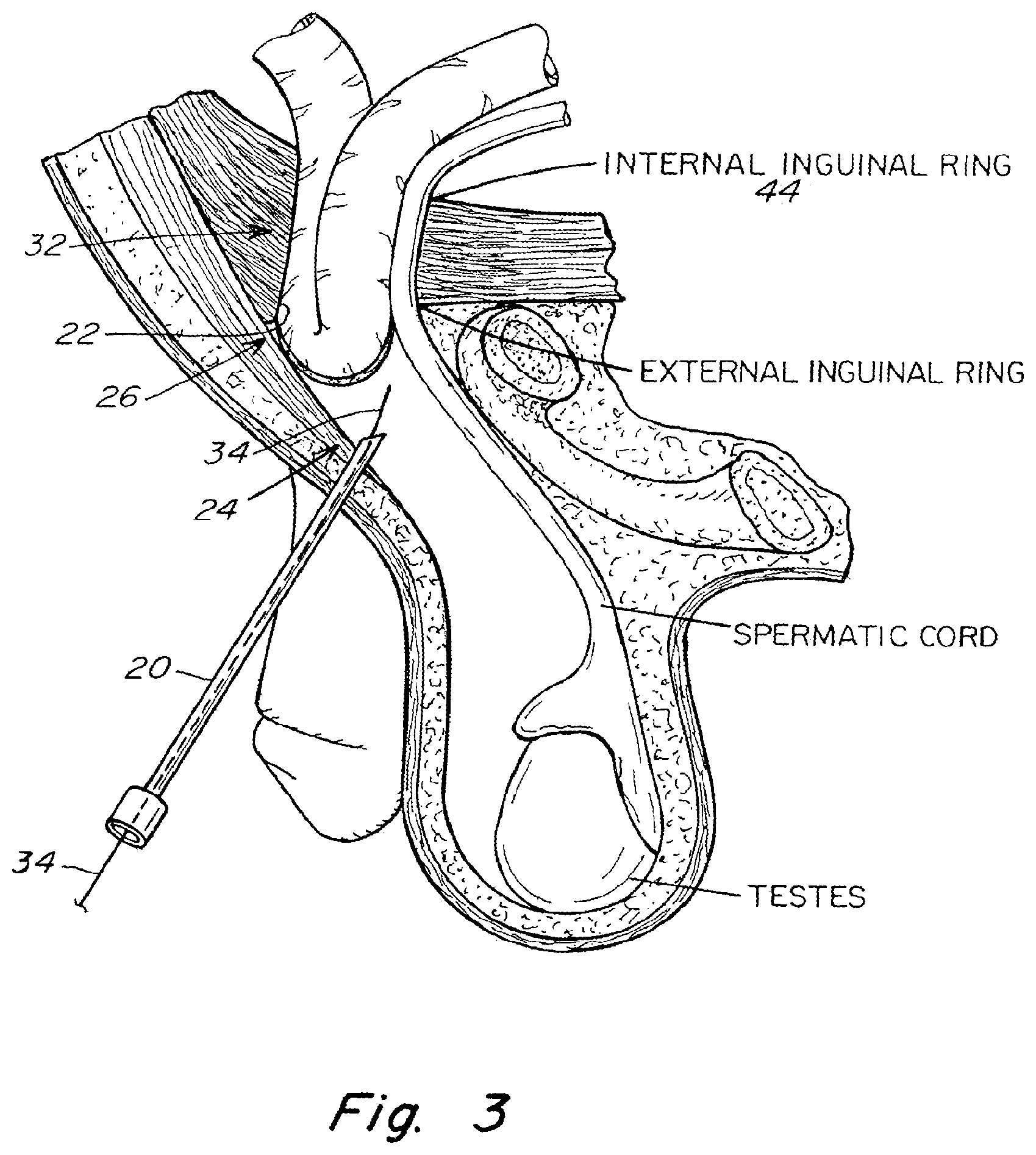 Patent US11771542 Figure 3 – Method and prosthesis for percutaneous hernia repair