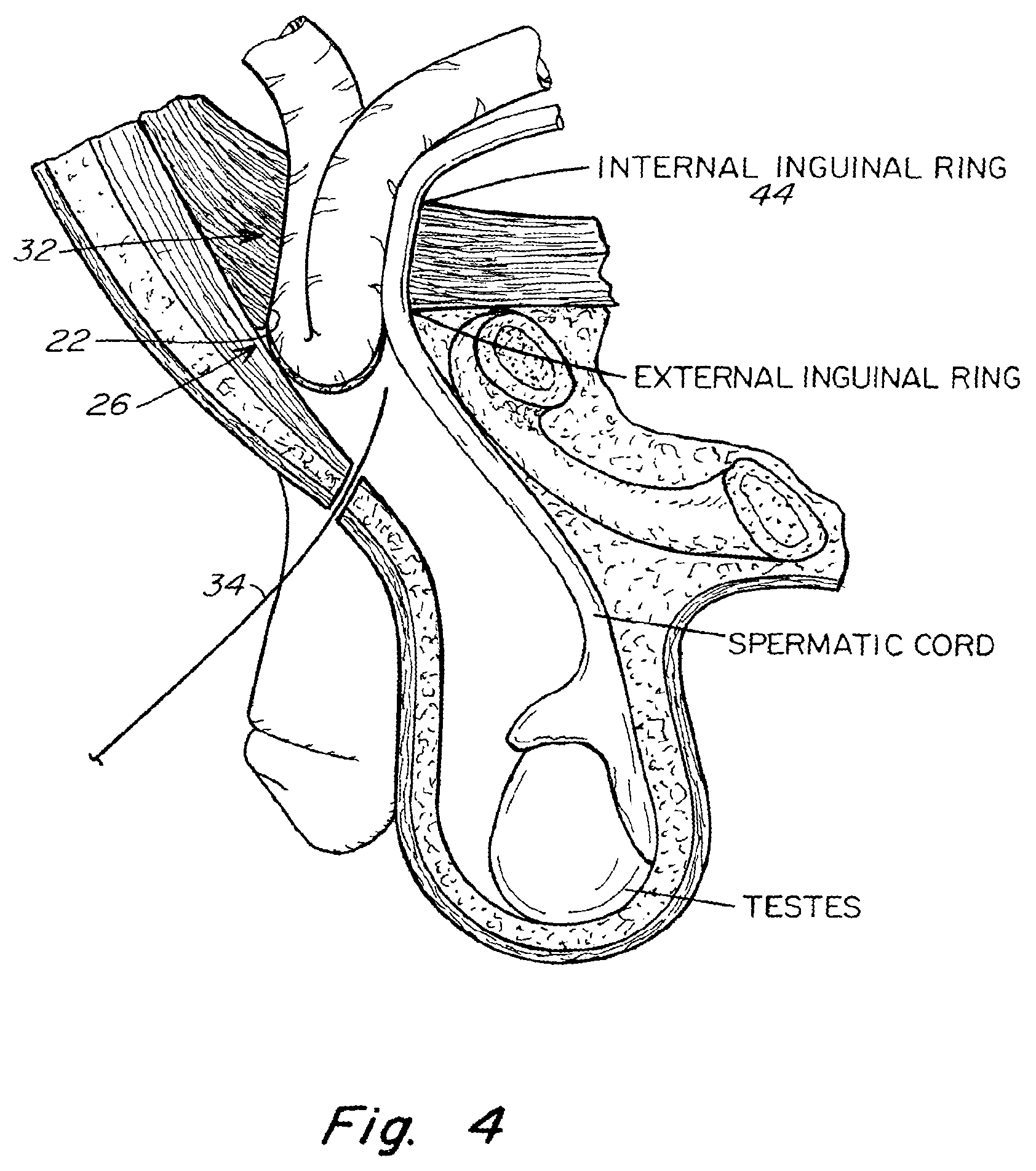 Patent US11771542 Figure 4 – Method and prosthesis for percutaneous hernia repair
