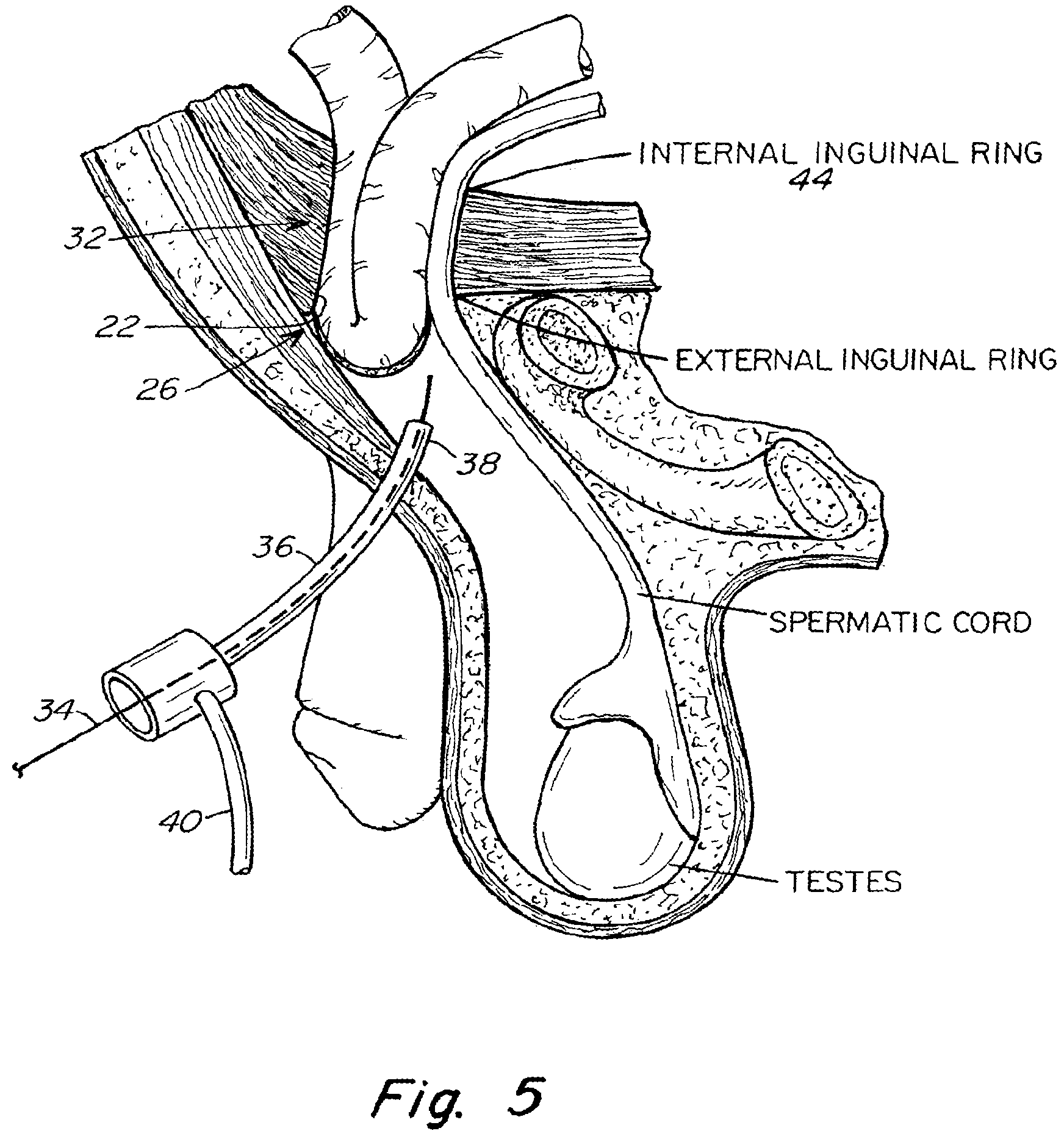 Patent US11771542 Figure 5 – Method and prosthesis for percutaneous hernia repair