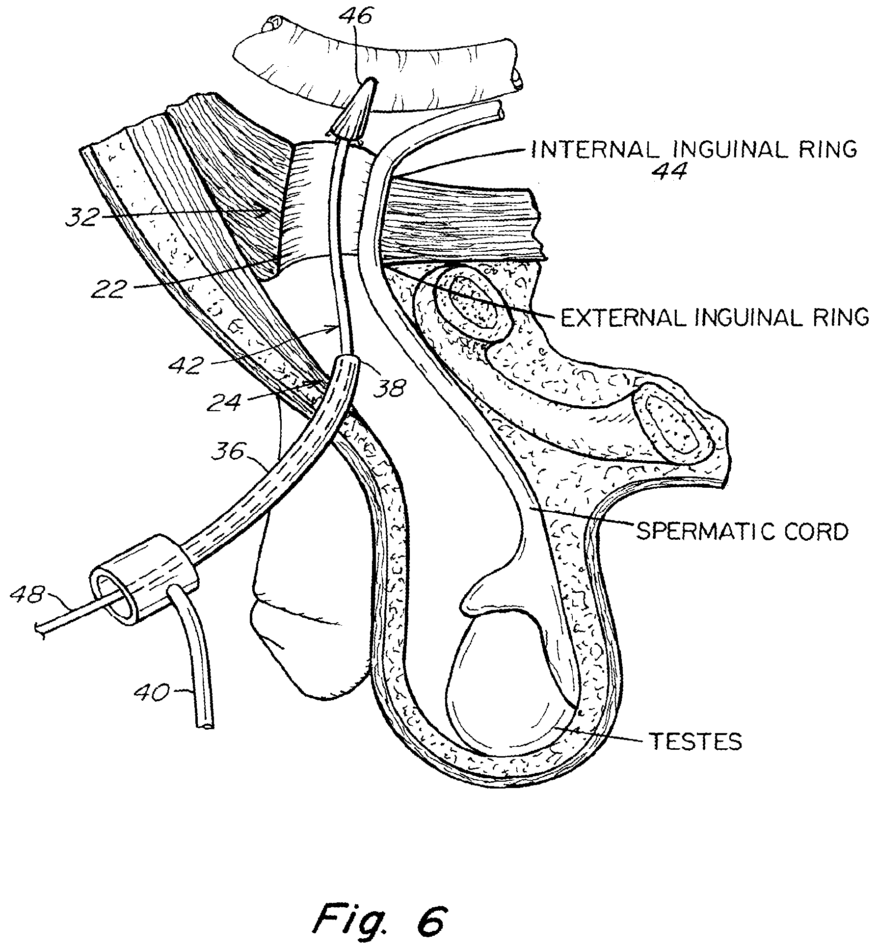 Patent US11771542 Figure 6 – Method and prosthesis for percutaneous hernia repair