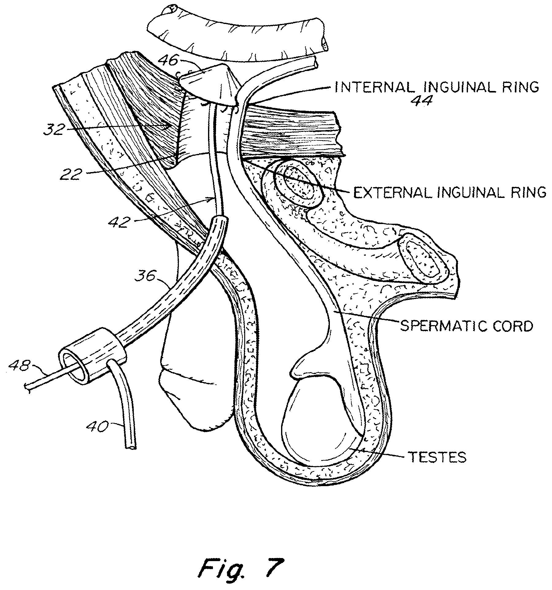 Patent US11771542 Figure 7 – Method and prosthesis for percutaneous hernia repair